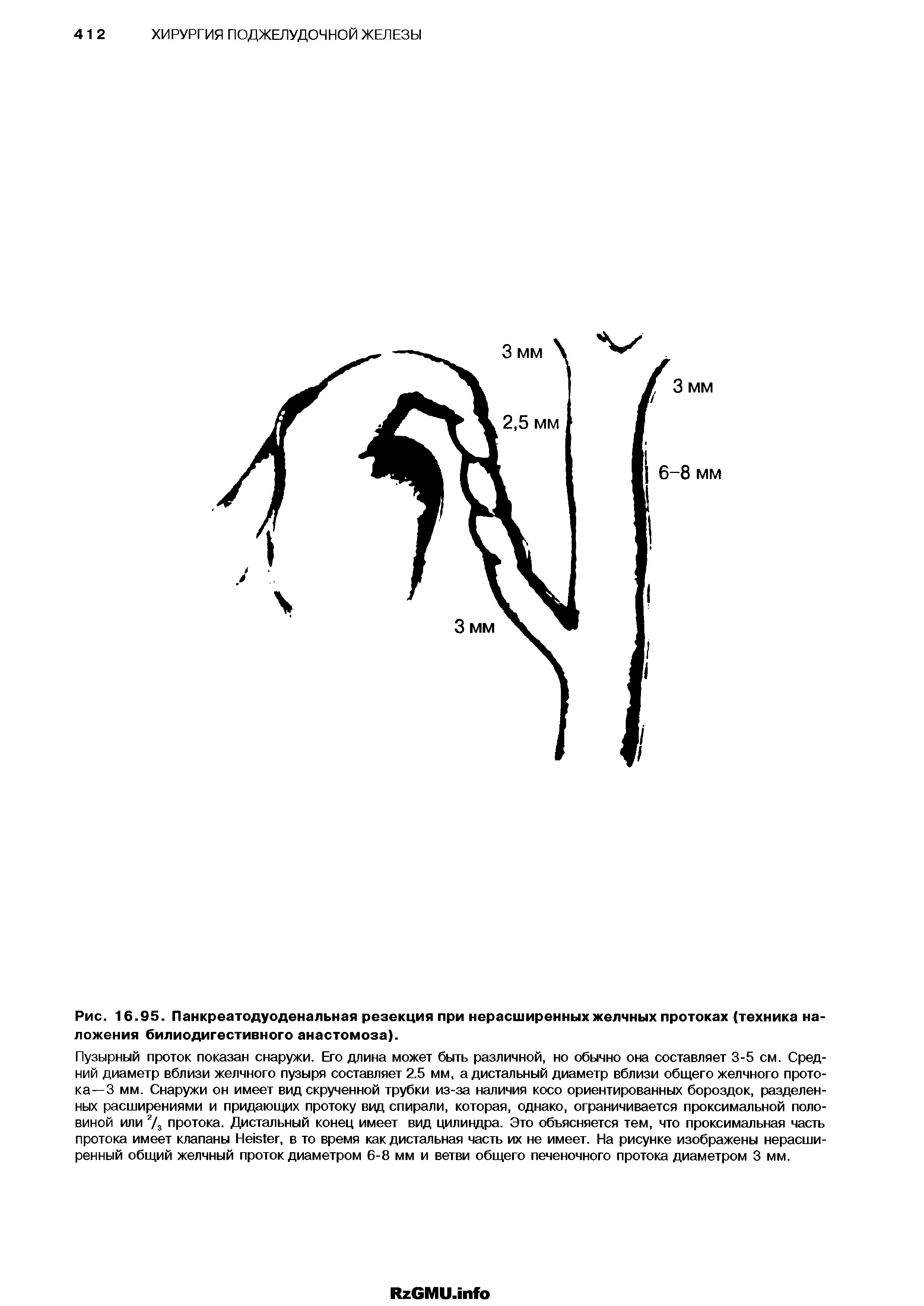 Рис. 16.95. Панкреатодуоденальная резекция при нерасширенных желчных протоках (техника наложения билиодигестивного анастомоза).