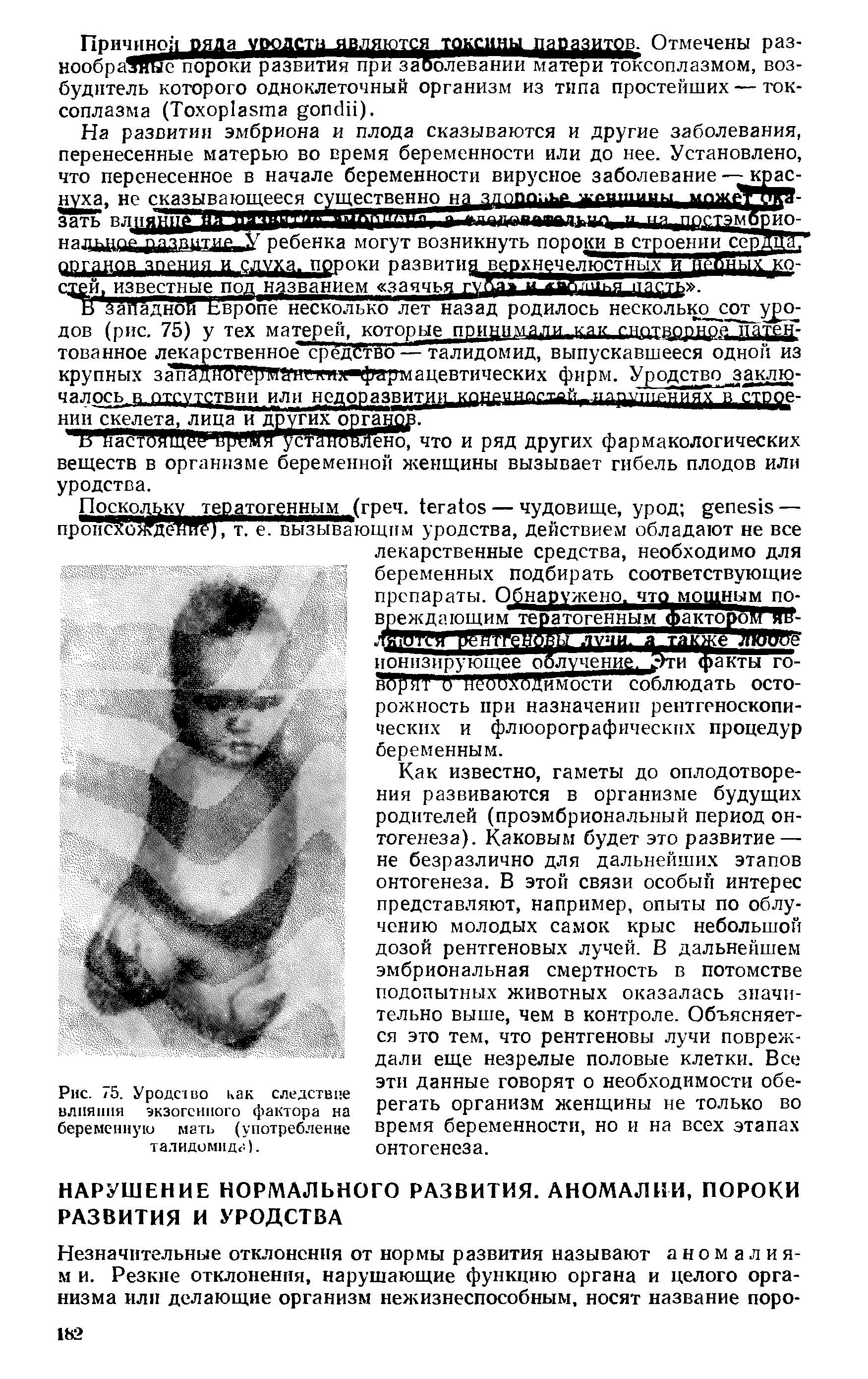 Рис. 75. Уродство как следствие влияния экзогенного фактора на беременную мать (употребление талидомида).