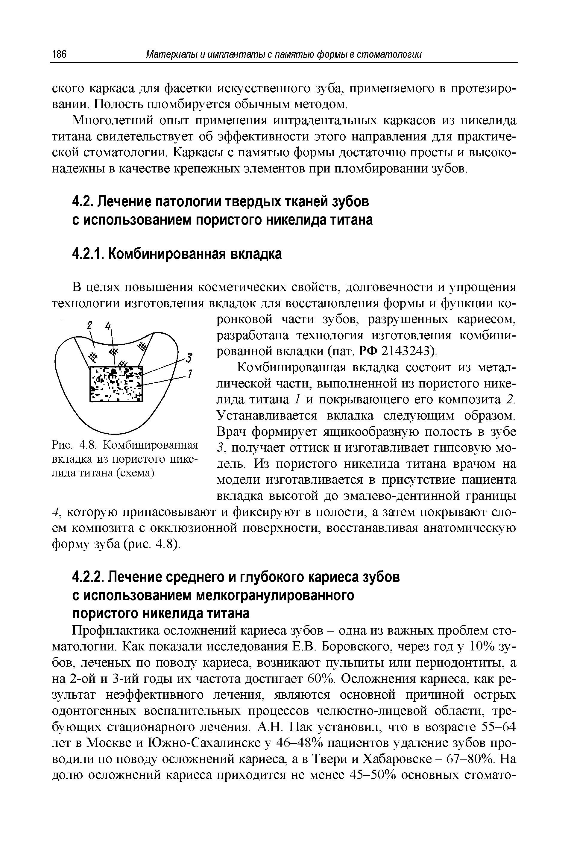 Рис. 4.8. Комбинированная вкладка из пористого никелида титана (схема)...