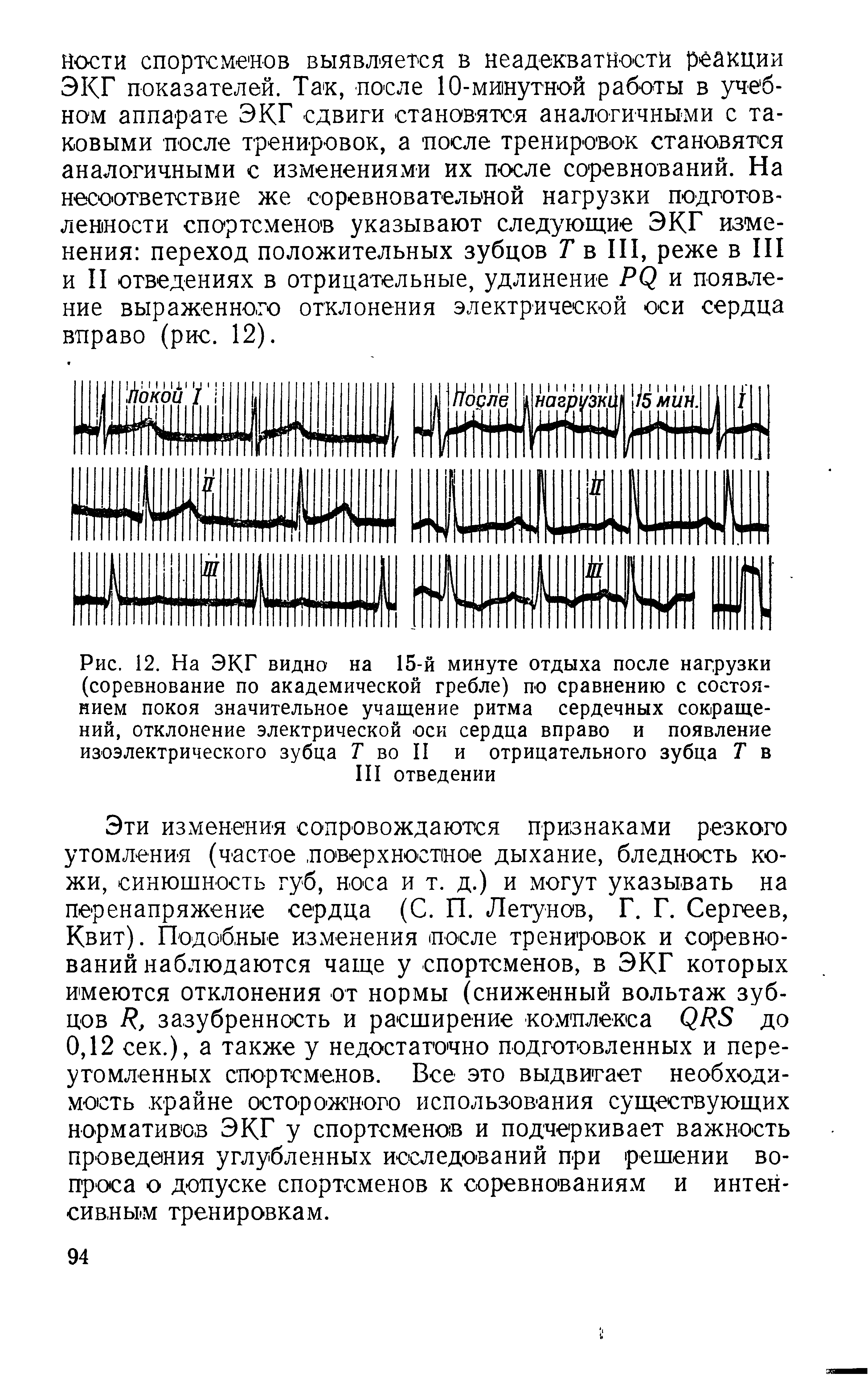 Рис. 12. На ЭКГ видно на 15-й минуте отдыха после нагрузки (соревнование по академической гребле) по сравнению с состоянием покоя значительное учащение ритма сердечных сокращений, отклонение электрической -оси сердца вправо и появление изоэлектрического зубца Т во II и отрицательного зубца Т в III отведении...