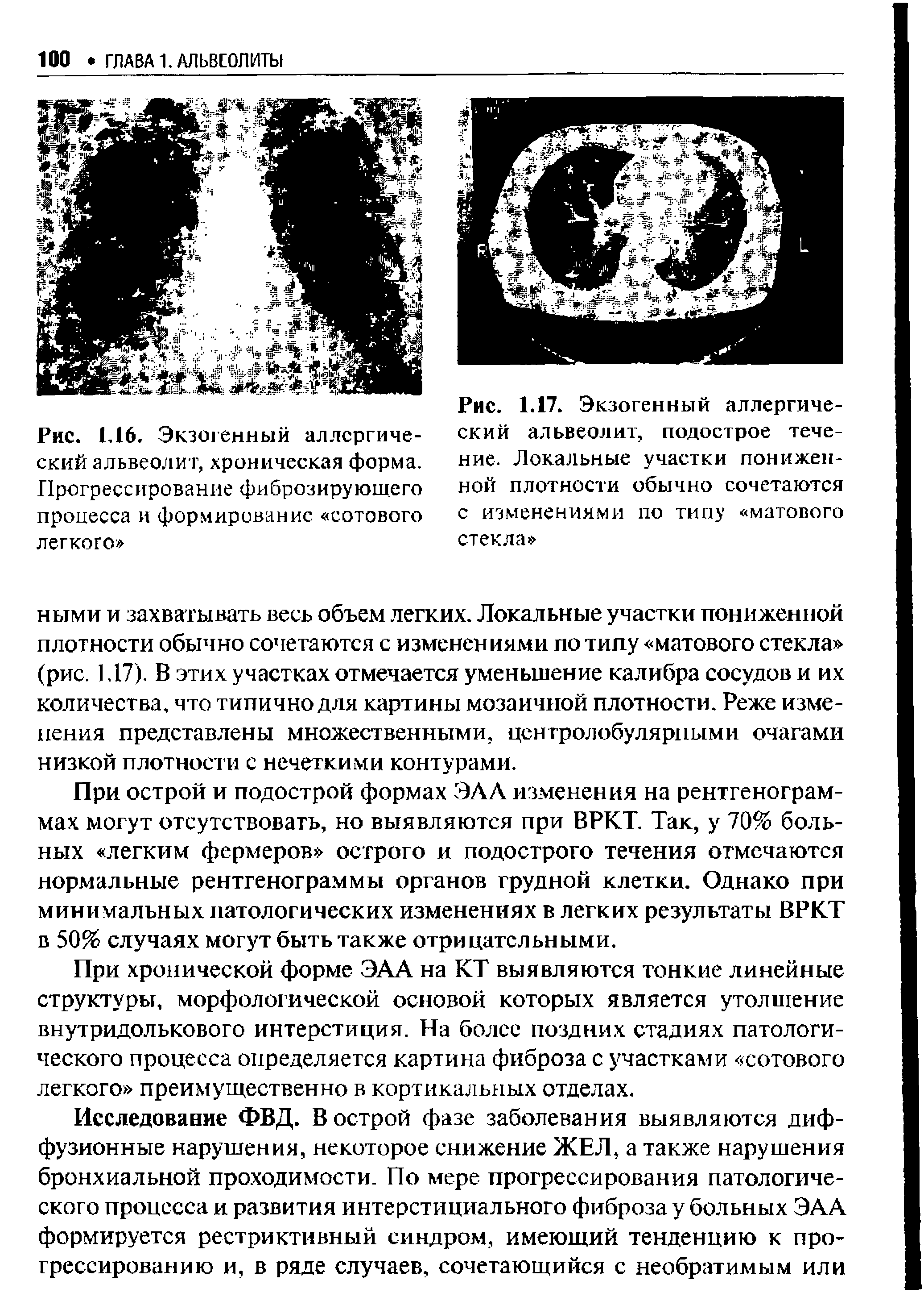 Рис. 1.16. Экзогенный аллергический альвеолит, хроническая форма. Прогрессирование фиброзирующего процесса и формирование сотового легкого ...