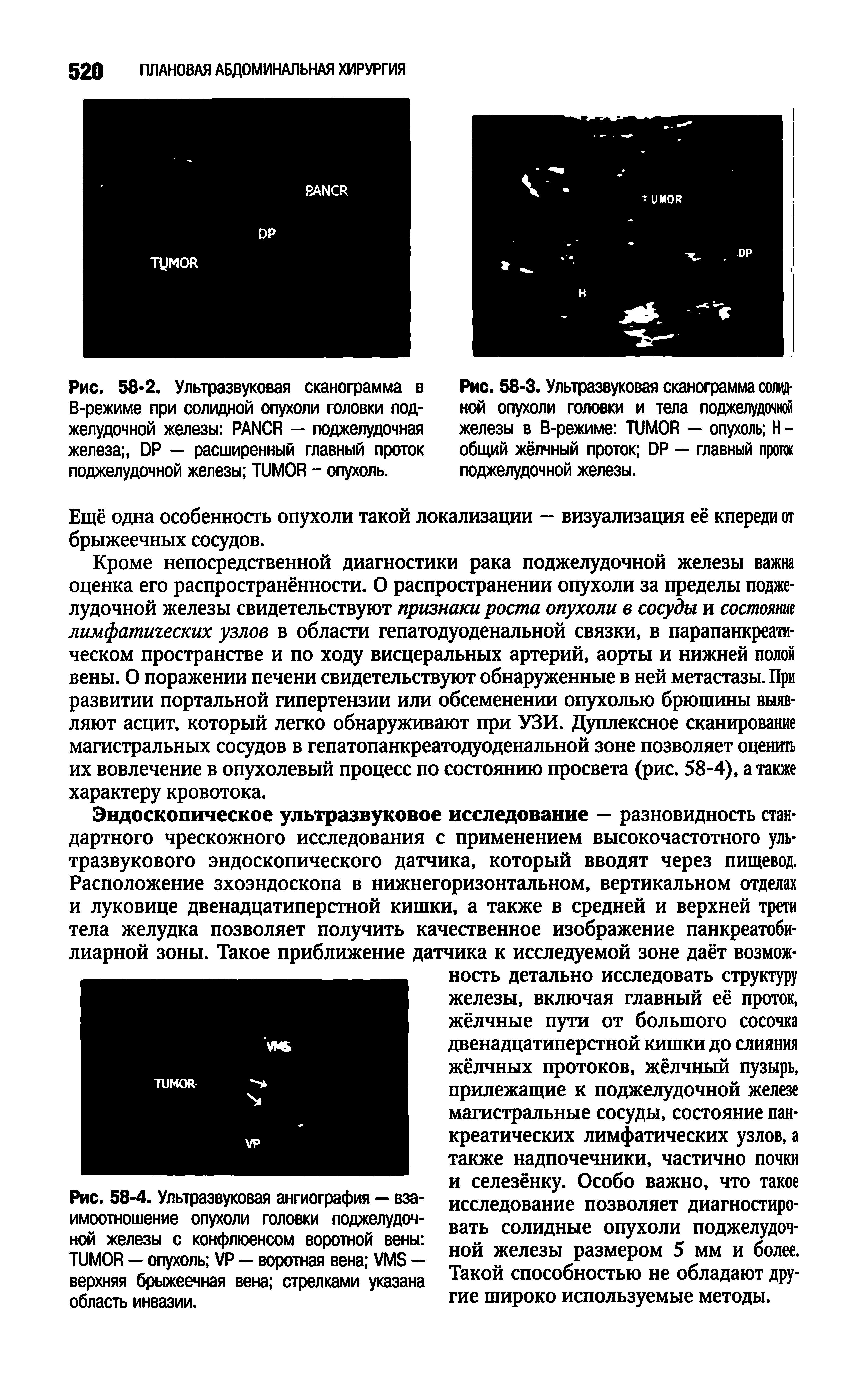 Рис. 58-4. Ультразвуковая ангиография — взаимоотношение опухоли головки поджелудочной железы с конфлюенсом воротной вены TUMOR — опухоль VP — воротная вена VMS — верхняя брыжеечная вена стрелками указана область инвазии.