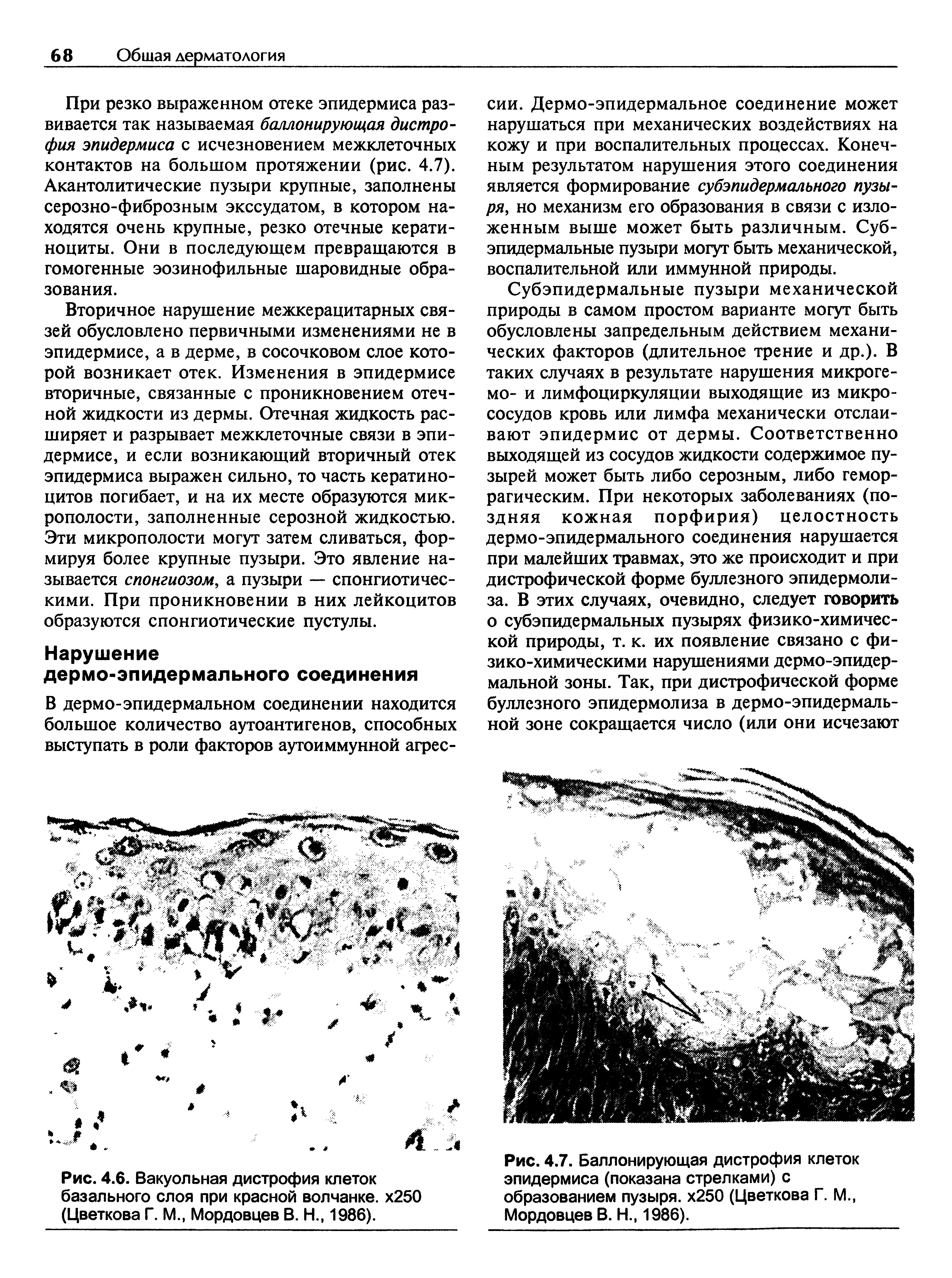 Рис. 4.7. Баллонирующая дистрофия клеток эпидермиса (показана стрелками) с образованием пузыря. х250 (Цветкова Г. М., Мордовцев В. Н., 1986).