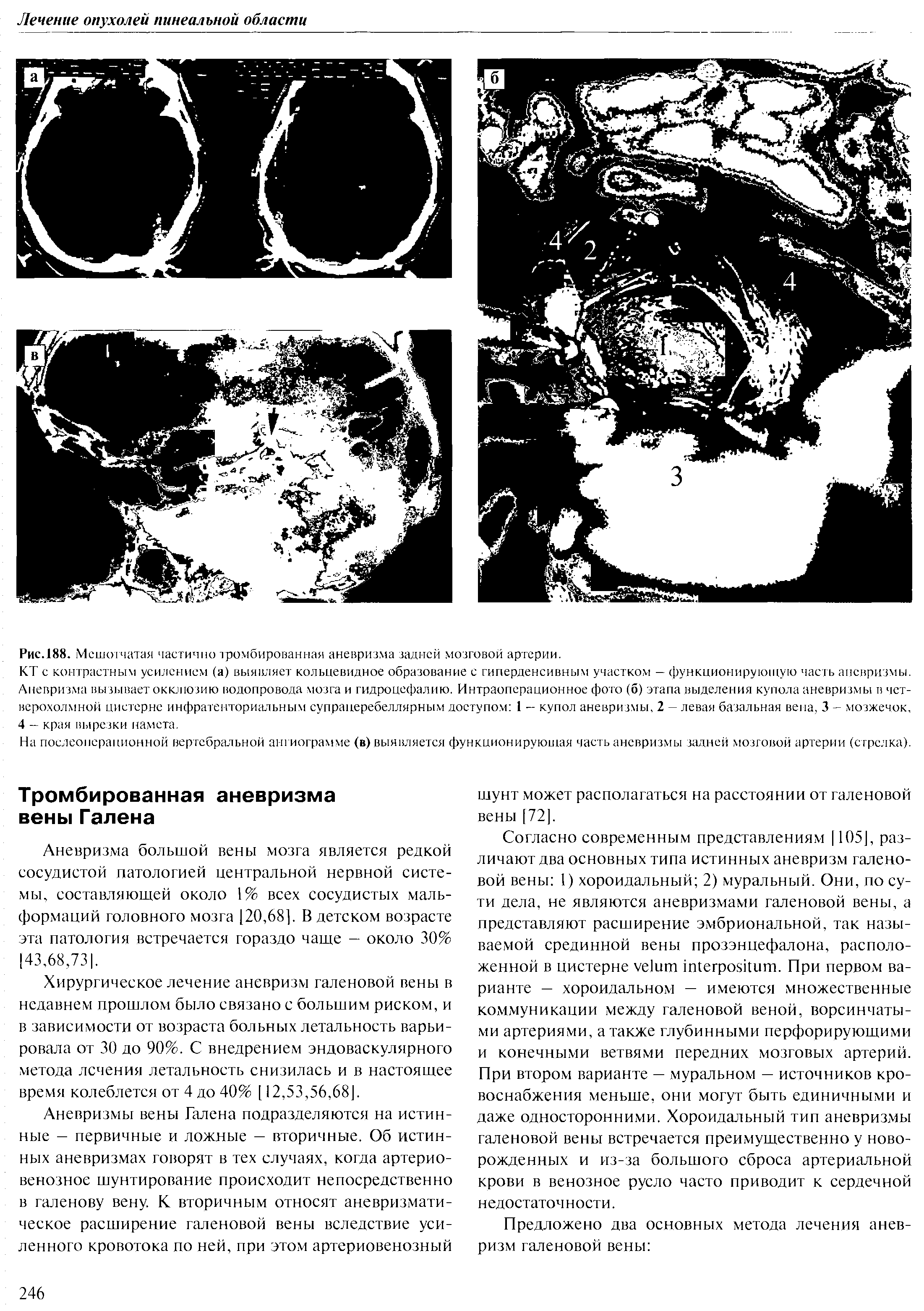 Рис.188. Мешотчатая частично тромбированная аневризма задней мозговой артерии.