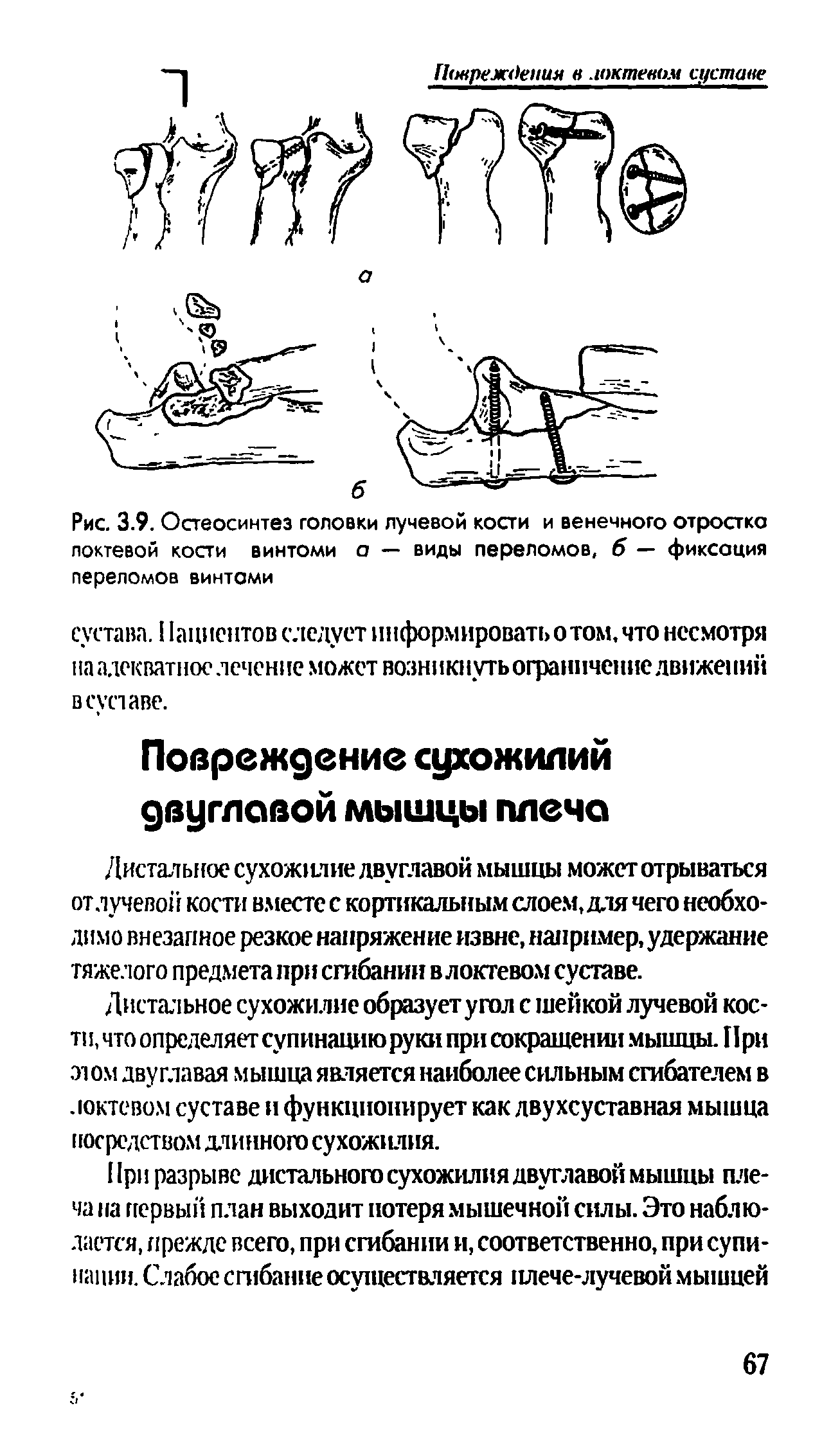 Рис. 3.9. Остеосинтез головки лучевой кости и венечного отростка локтевой кости винтоми о — виды переломов, б — фиксация переломов винтами...