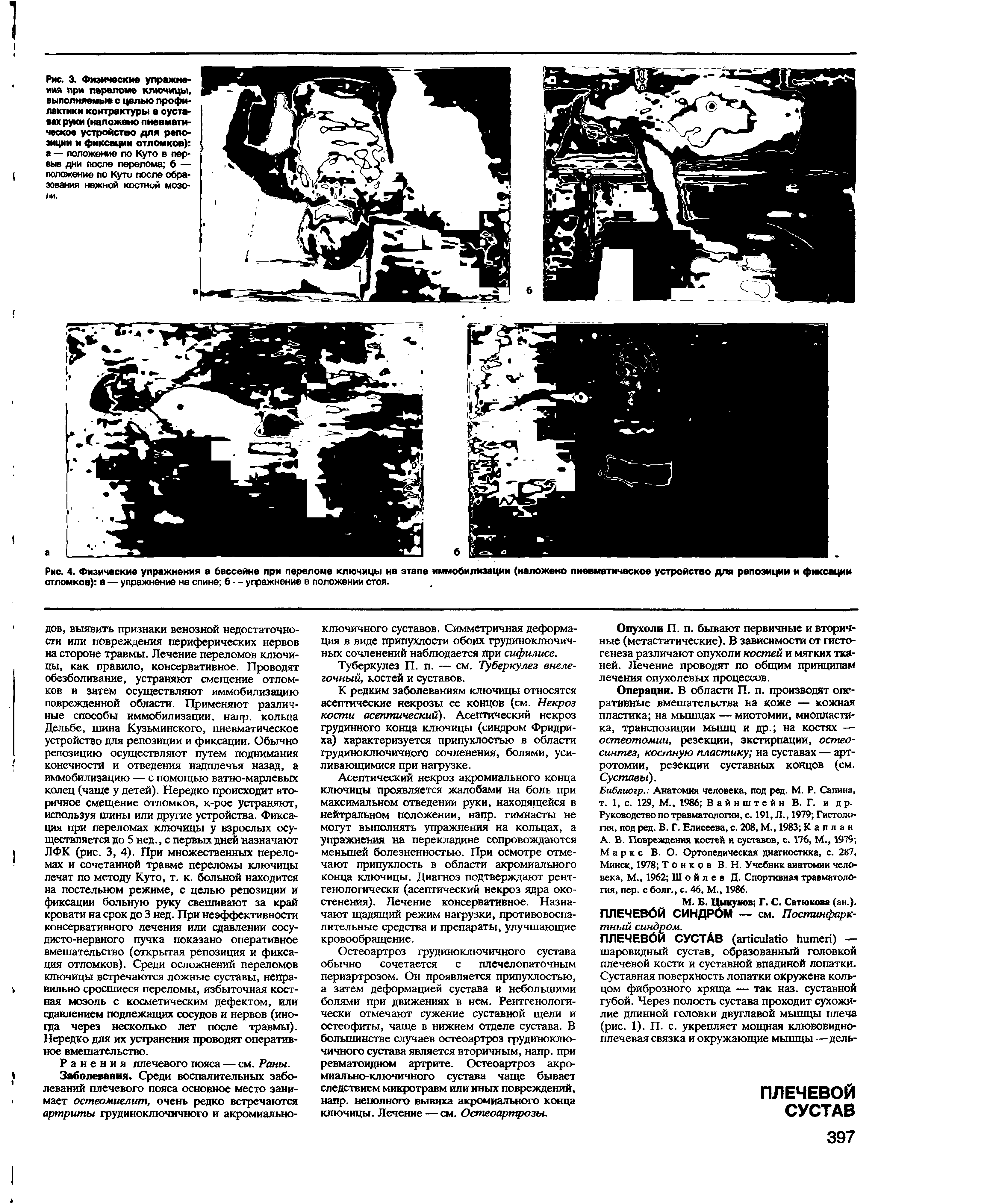 Рис. 4. Физические упражнения а бассейне при переломе ключицы на этапе иммобилизации (наложено пневматическое устройство для репозиции и фиксации отломков) а — упражнение на спине б - - упражнение в положении стоя.