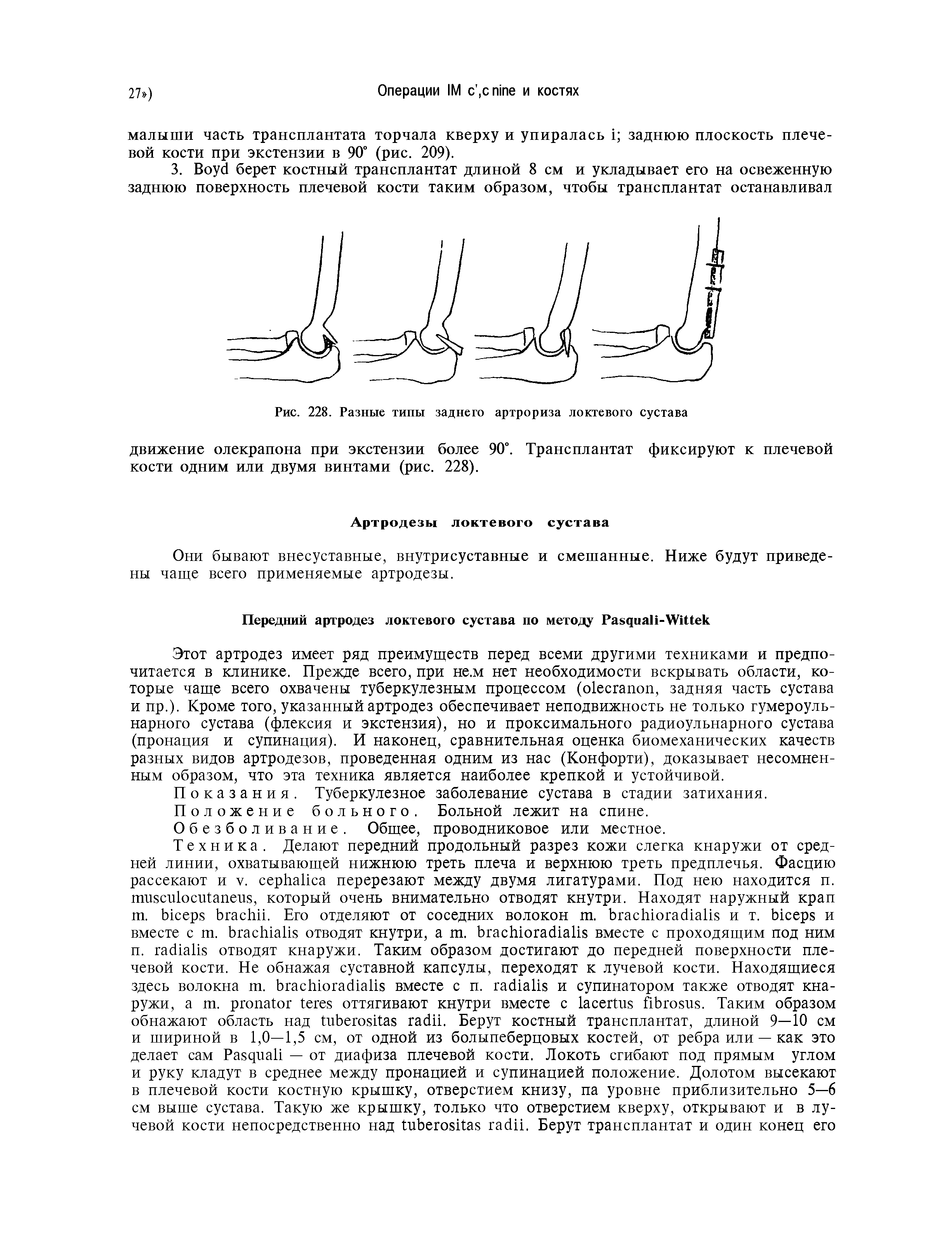 Рис. 228. Разные типы заднего артрориза локтевого сустава...