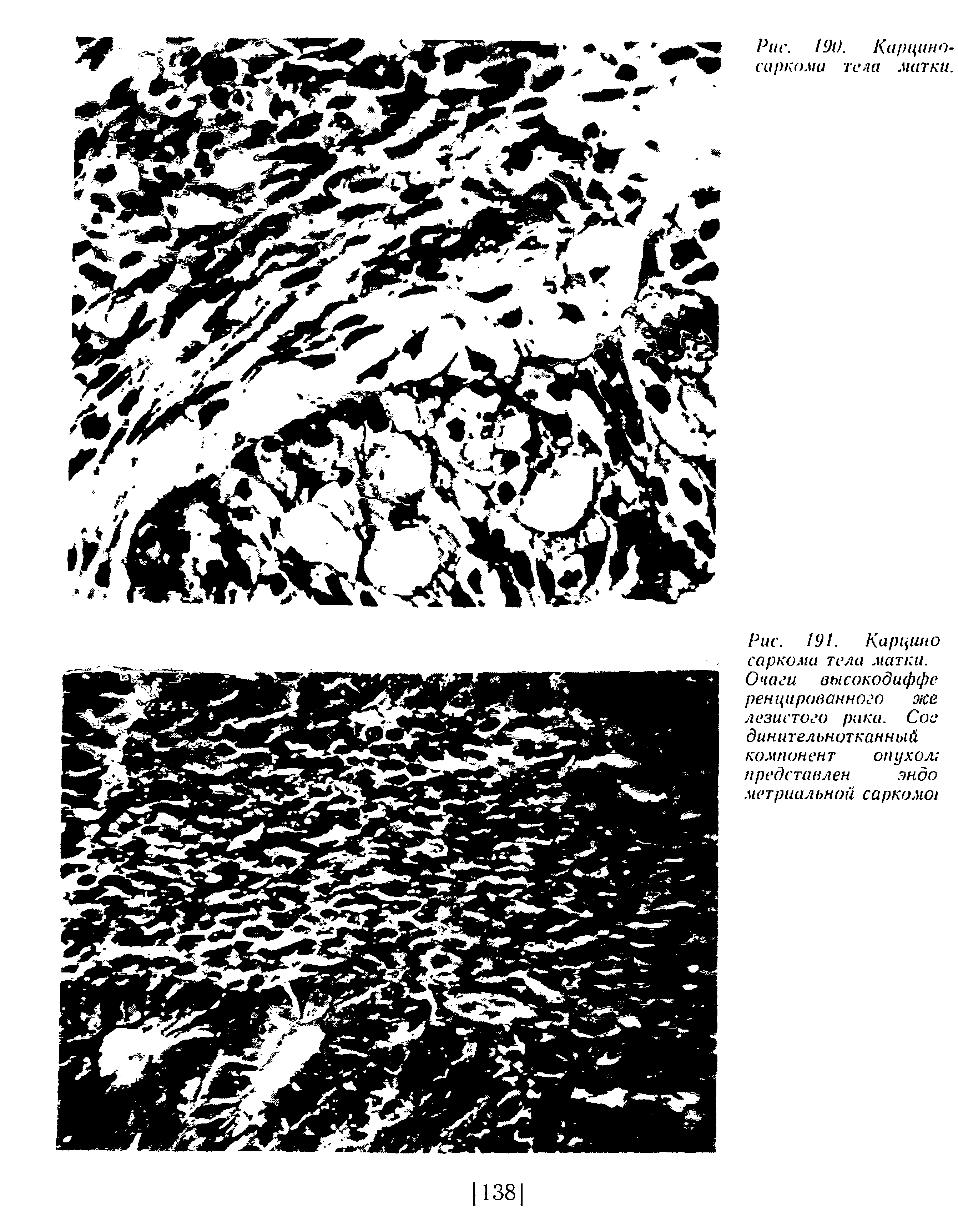 Рис. 191. Карципо саркома тела матки. Очаги высокодиффе ренцированного же лезистого рака. Сое дин и тел ьнотканный компонент опухол представлен эндо м е тр иал иной с а ркомо ...