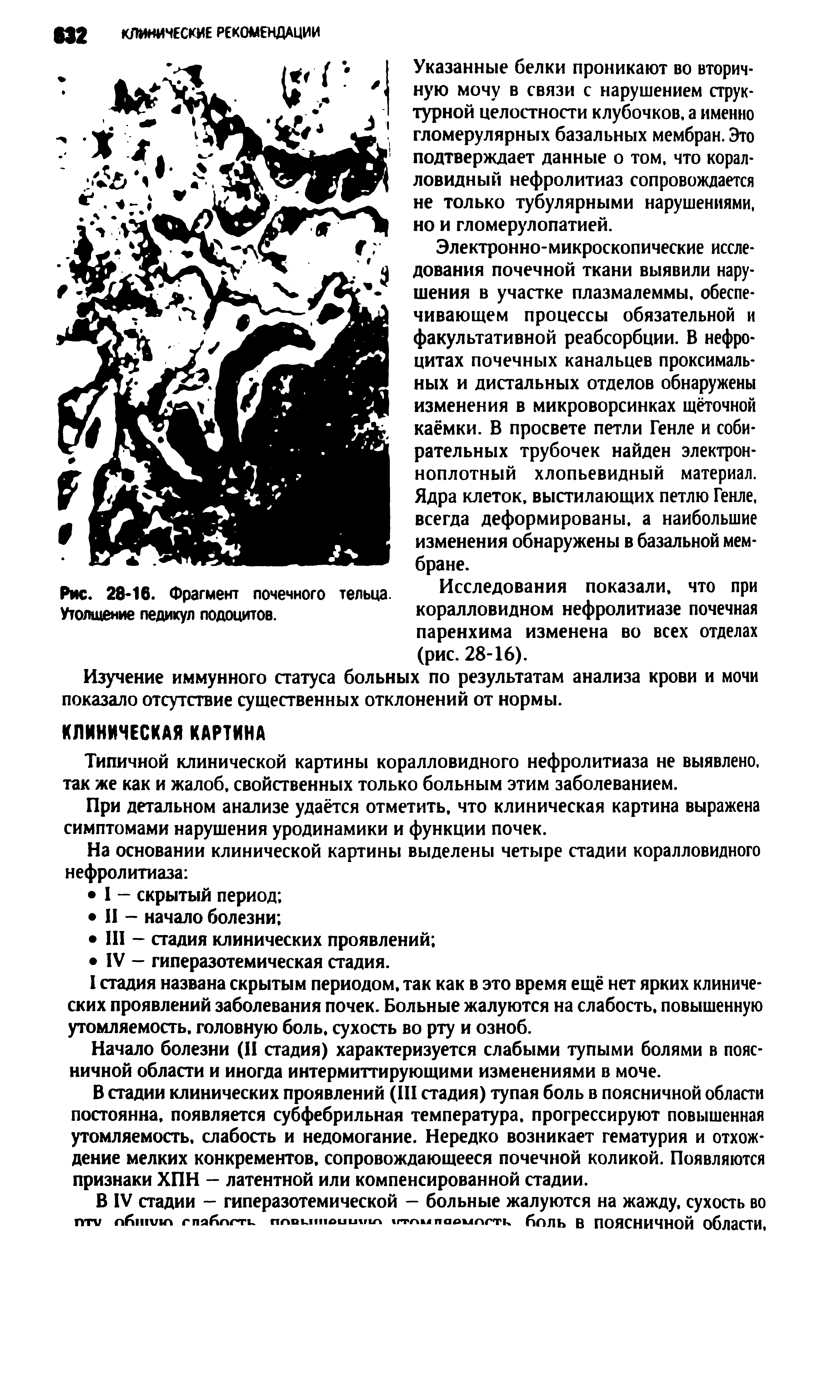 Рис. 28-16. Фрагмент почечного тельца Исследования показали, что при Утолщение педикул подоцитов. коралловидном нефролитиазе почечная...