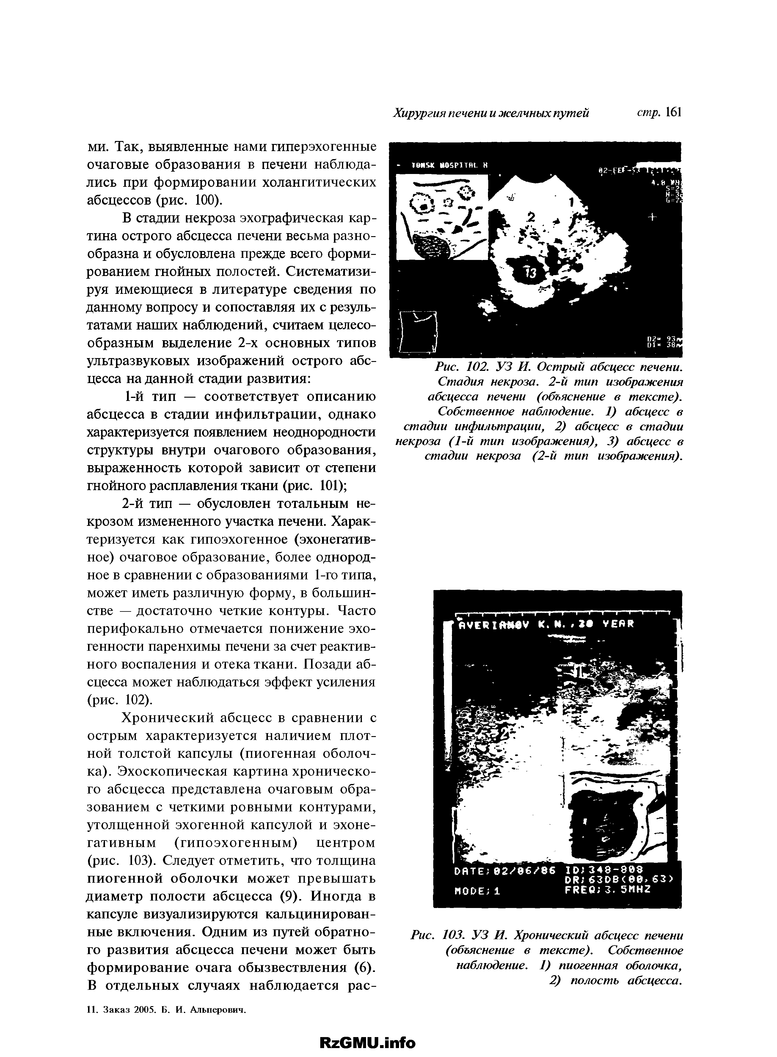 Рис. 103. УЗ И. Хронический абсцесс печени (объяснение в тексте). Собственное наблюдение. 1) пиогенная оболочка, 2) полость абсцесса.