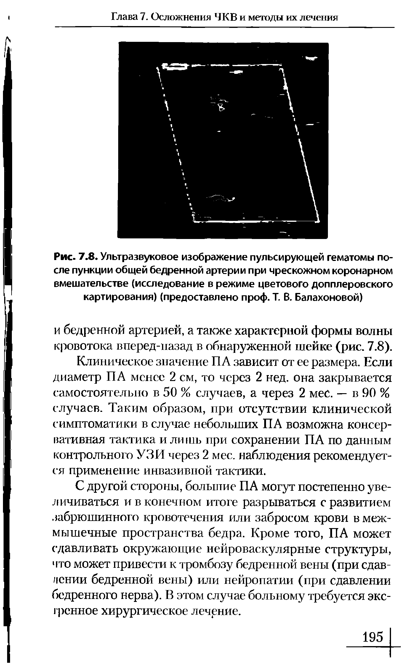 Рис. 7.8. Ультразвуковое изображение пульсирующей гематомы после пункции общей бедренной артерии при чрескожном коронарном вмешательстве (исследование в режиме цветового допплеровского картирования) (предоставлено проф. Т. В. Балахоновой)...