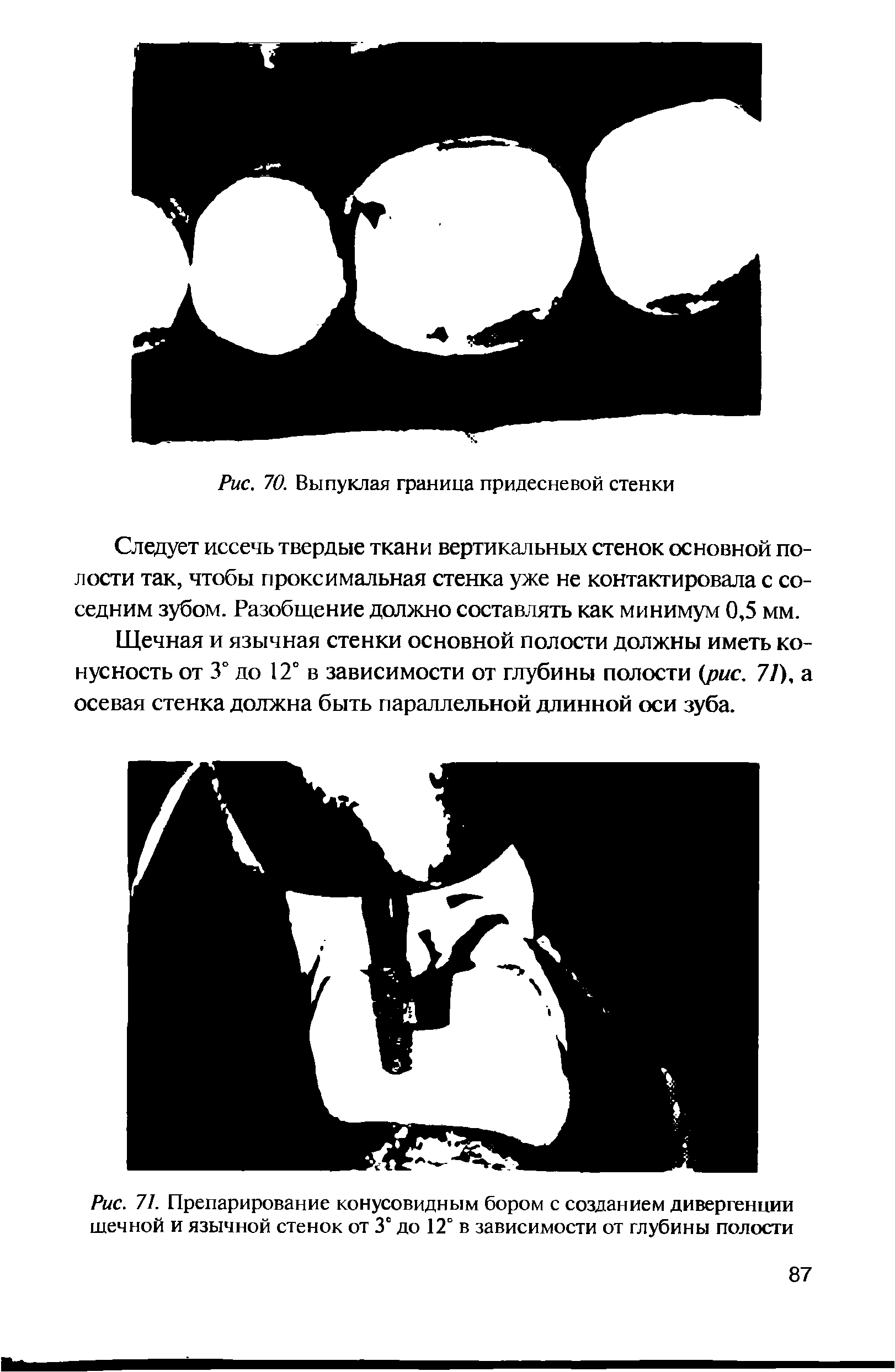 Рис. 71. Препарирование конусовидным бором с созданием дивергенции шечной и язычной стенок от 3° до 12° в зависимости от глубины полости...