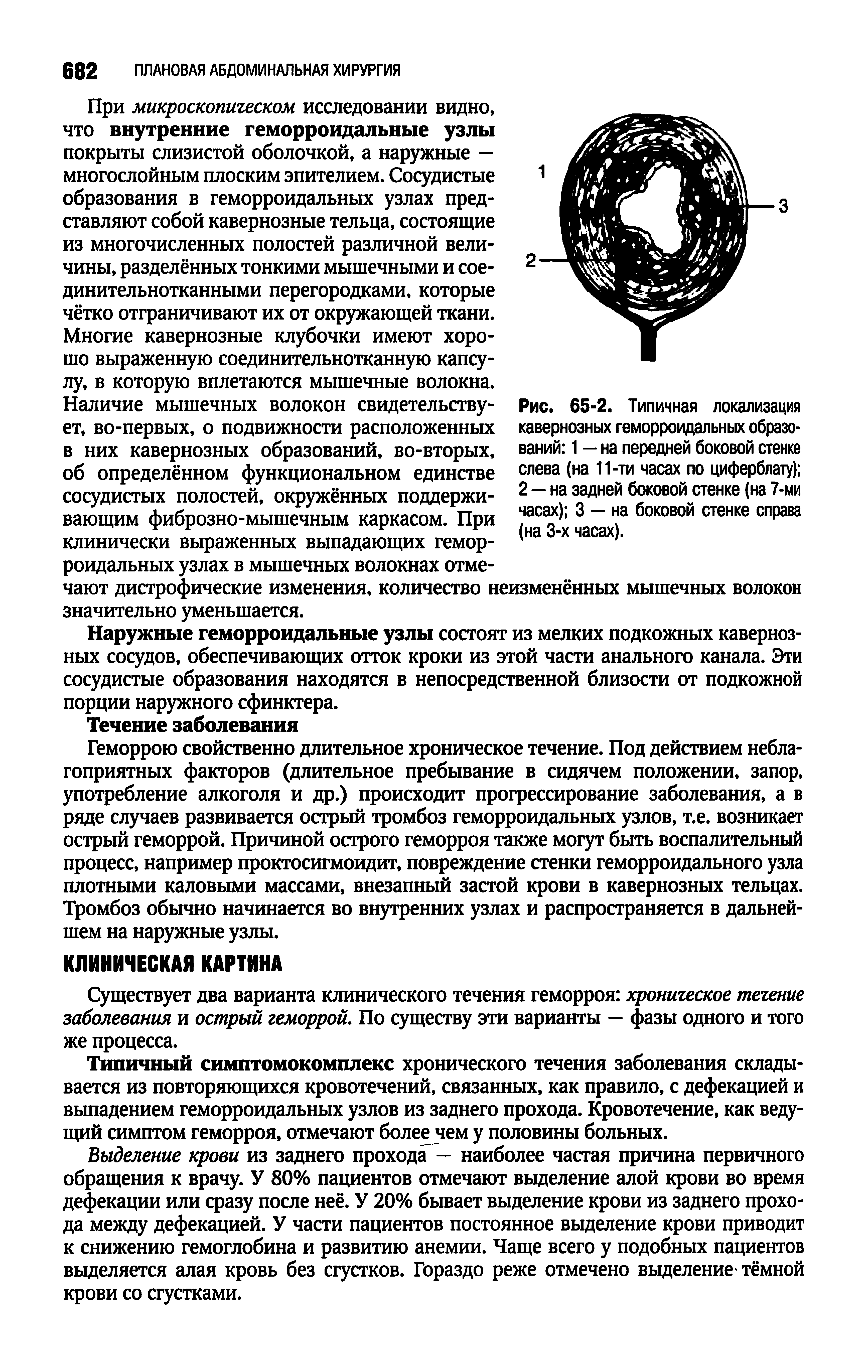 Рис. 65-2. Типичная локализация кавернозных геморроидальных образований 1 — на передней боковой стенке слева (на 11-ти часах по циферблату) 2 — на задней боковой стенке (на 7-ми часах) 3 — на боковой стенке справа (на 3-х часах).