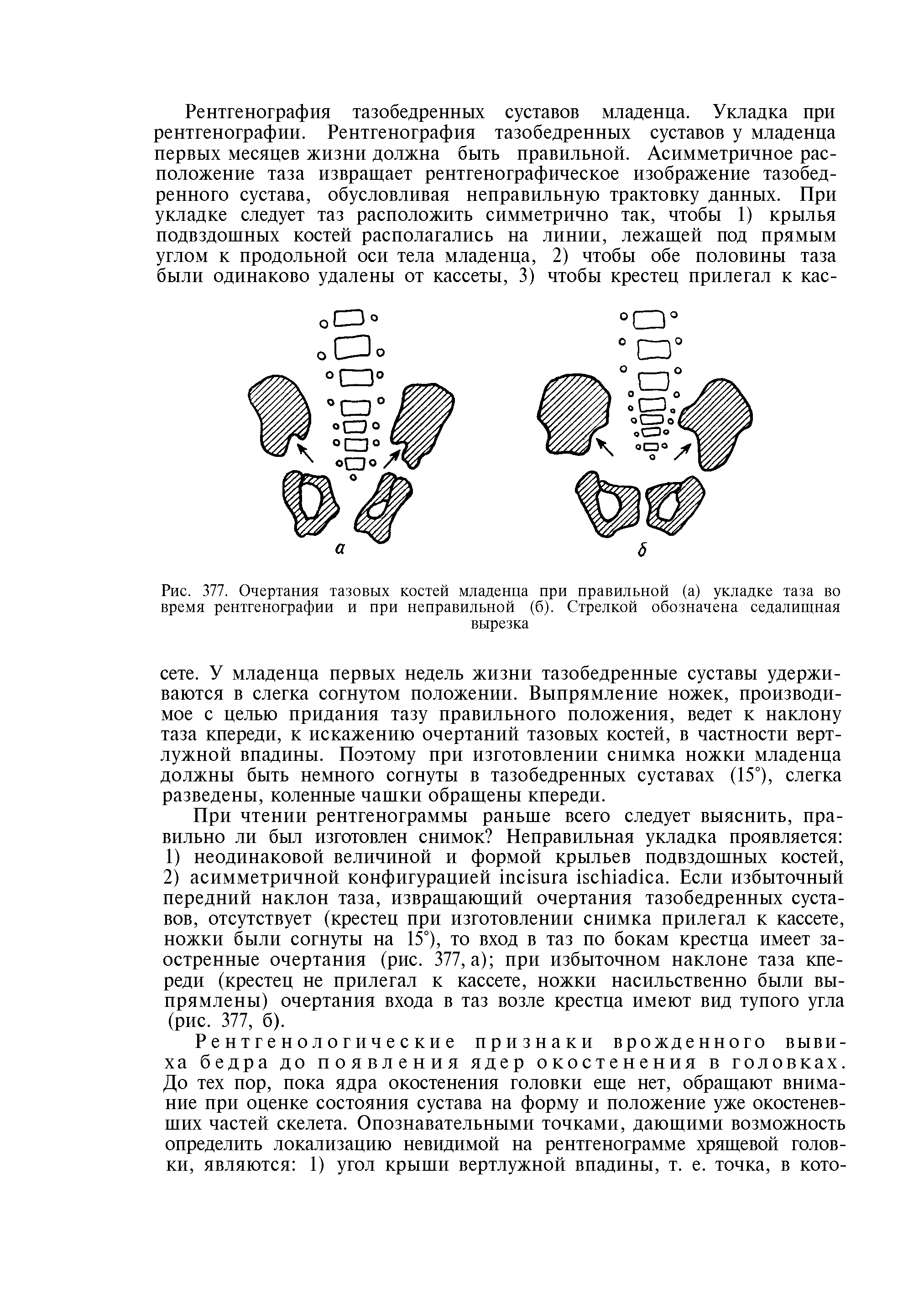 Рис. 377. Очертания тазовых костей младенца при правильной (а) укладке таза во время рентгенографии и при неправильной (б). Стрелкой обозначена седалищная вырезка...