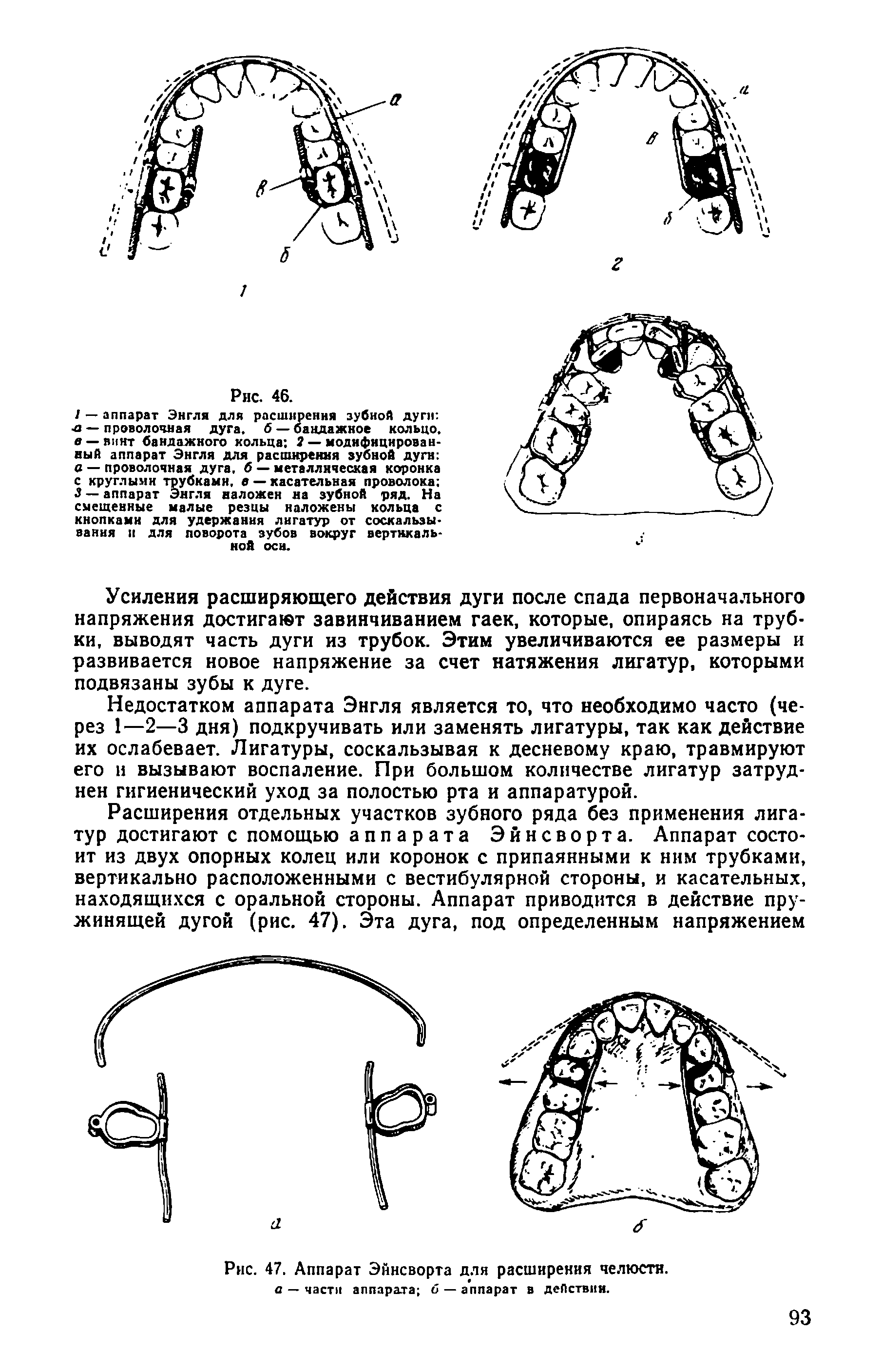 Рис. 47. Аппарат Эйнсворта для расширения челюсти, а — части аппарата б —аппарат в действии.