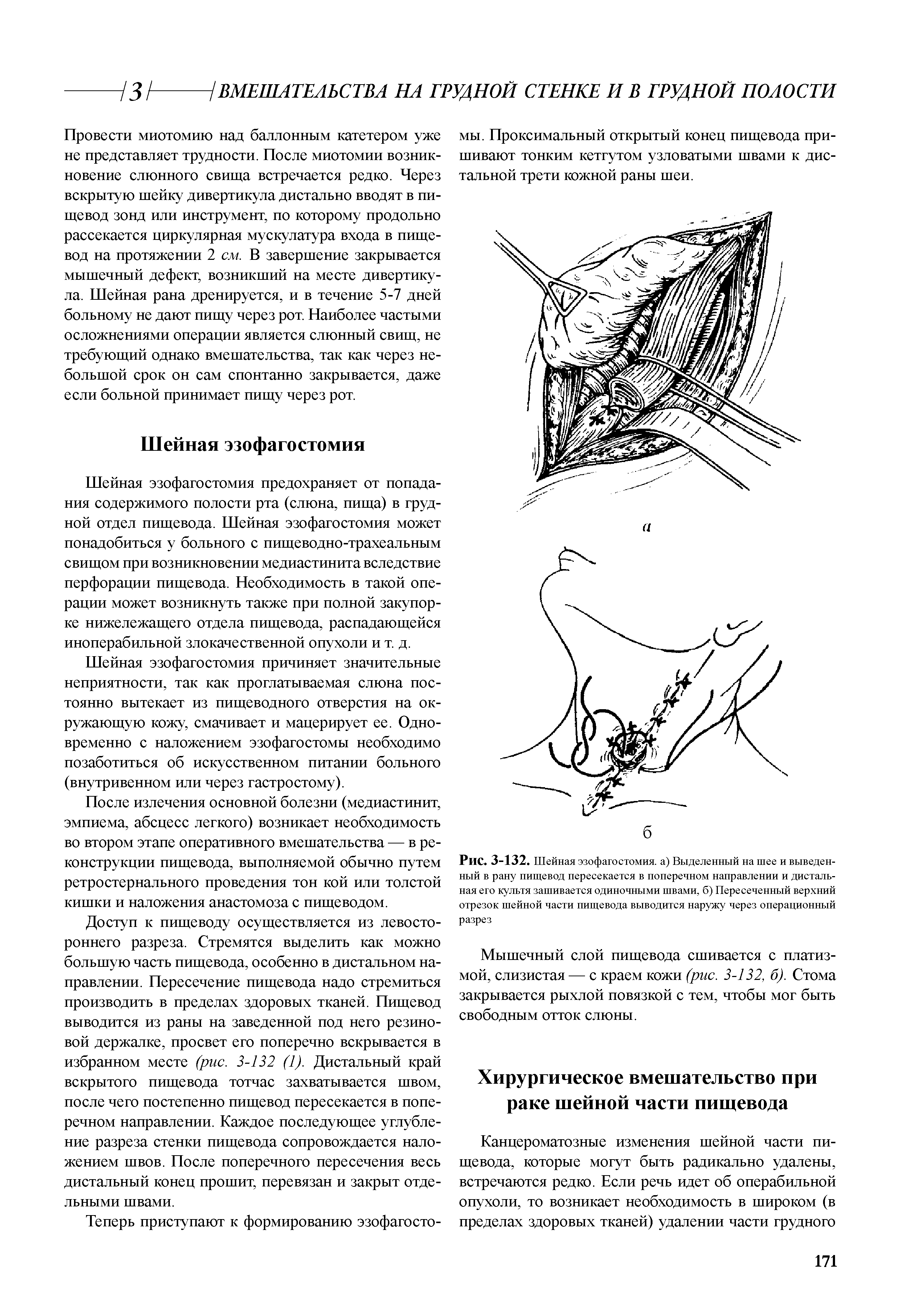 Рис. 3-132. Шейная эзофагостомия. а) Выделенный на шее и выведенный в рану пищевод пересекается в поперечном направлении и дистальная его культя зашивается одиночными швами, б) Пересеченный верхний отрезок шейной части пищевода выводится наружу через операционный разрез...