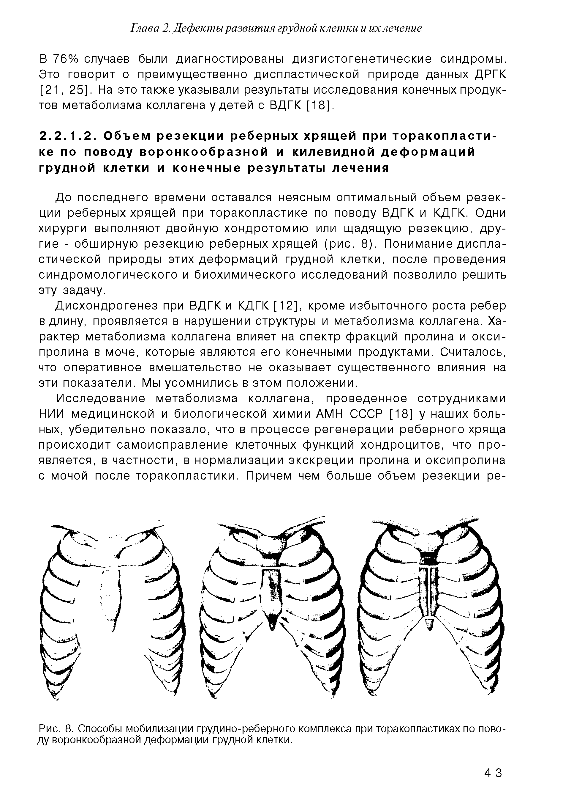 Рис. 8. Способы мобилизации грудино-реберного комплекса при торакопластиках по поводу воронкообразной деформации грудной клетки.