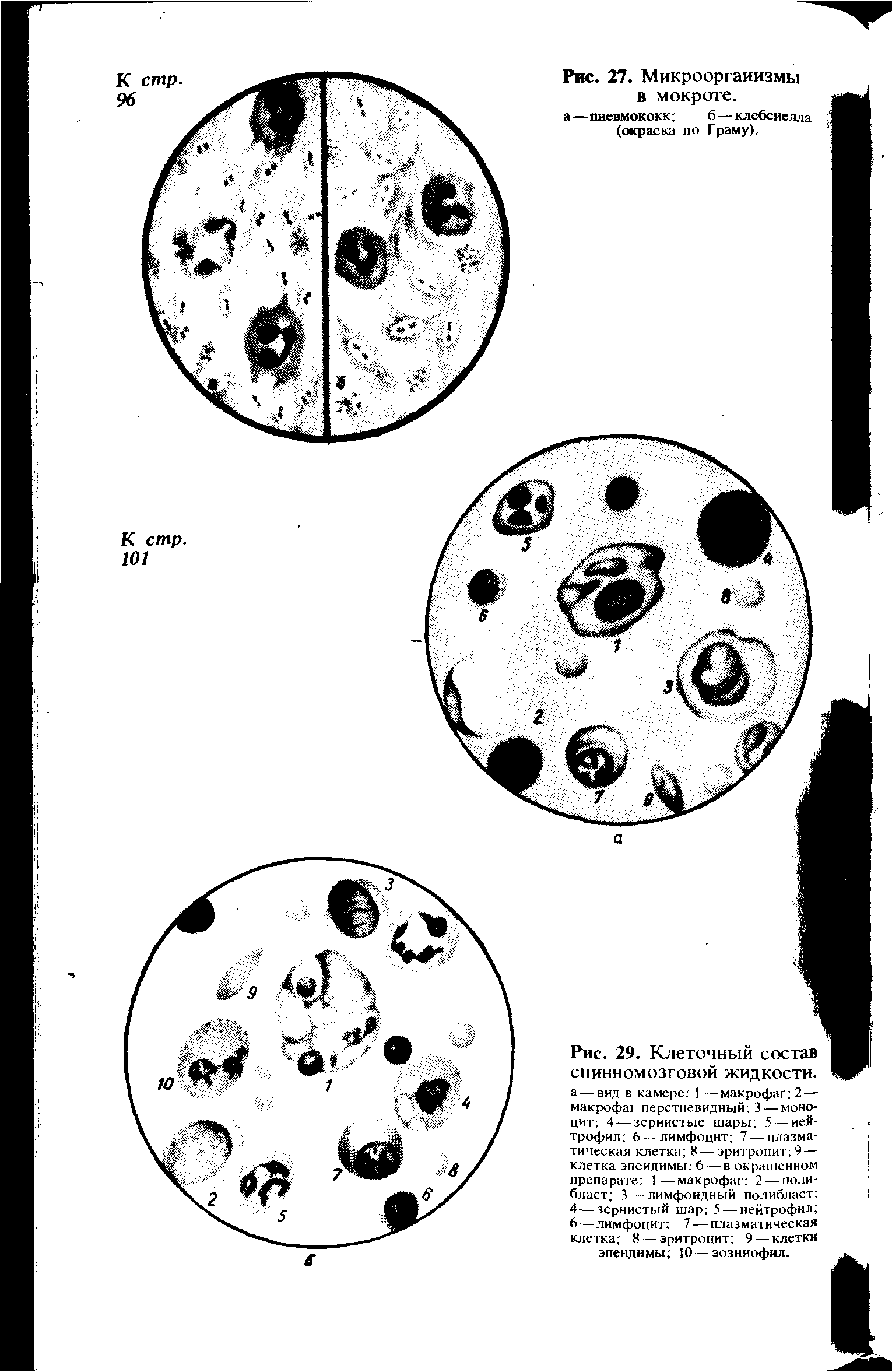 Рис. 29. Клеточный состав спинномозговой жидкости, а—вид в камере 1—макрофаг 2 — макрофаг перстневидный 3 — моноцит 4 — зернистые шары 5 — нейтрофил 6 — лимфоцит 7 — плазматическая клетка 8 — эритроцит 9 — клетка эпендимы 6 — в окрашенном препарате 1—макрофаг 2—полибласт 3—лимфоидный полибласт 4—зернистый шар 5 — нейтрофил 6-— лимфоцит 7 — плазматическая клетка 8 — эритроцит 9 — клетки эпендимы 10—эозинофил.