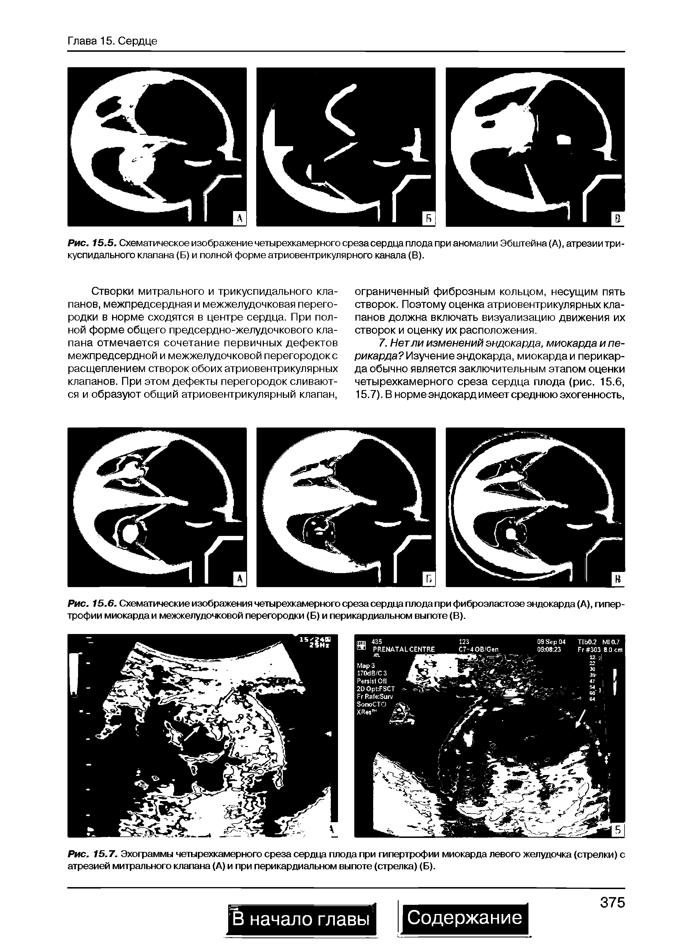 Рис. 15.5. Схематическое изображение четырехкамерного среза сердца плода при аномалии Эбштейна (А), атрезии трикуспидального клапана (Б) и полной форме атриовентрикулярного канала (В).