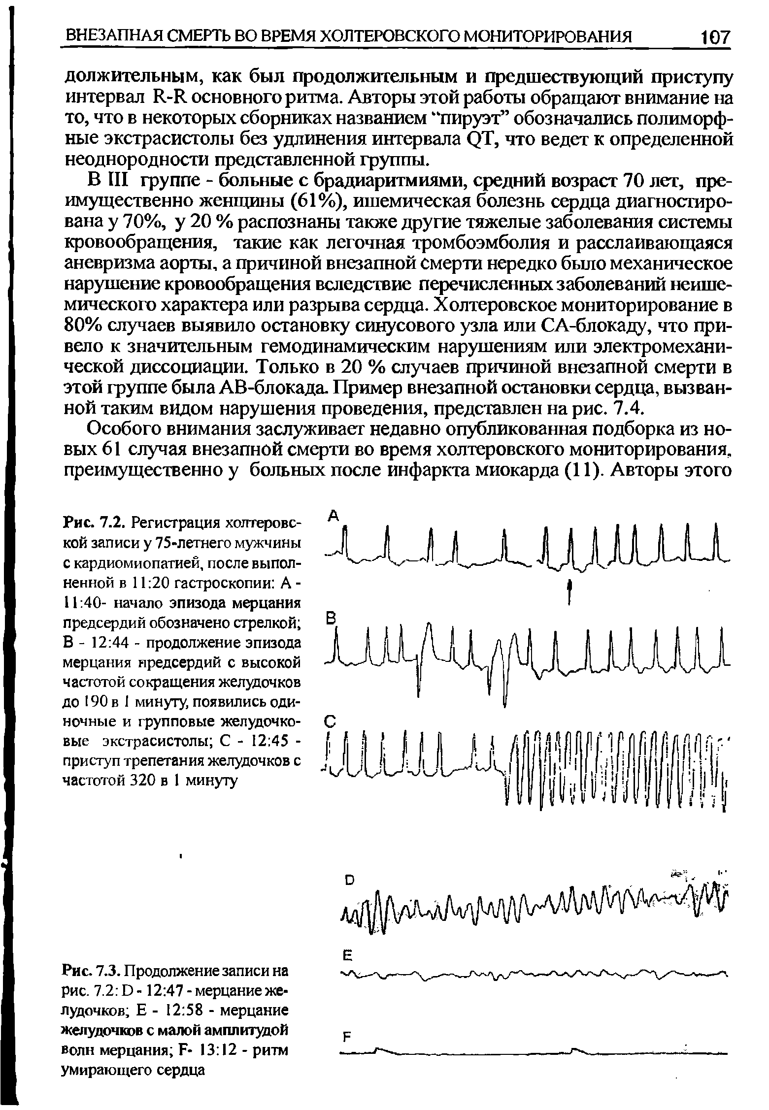 Рис. 7.3. Продолжение записи на рис. 7.2 П-12 47-мерцаниежелудочков Е - 12 58 - мерцание желудочков с малой амплитудой волн мерцания Е- 13 12 - ритм умирающего сердца...