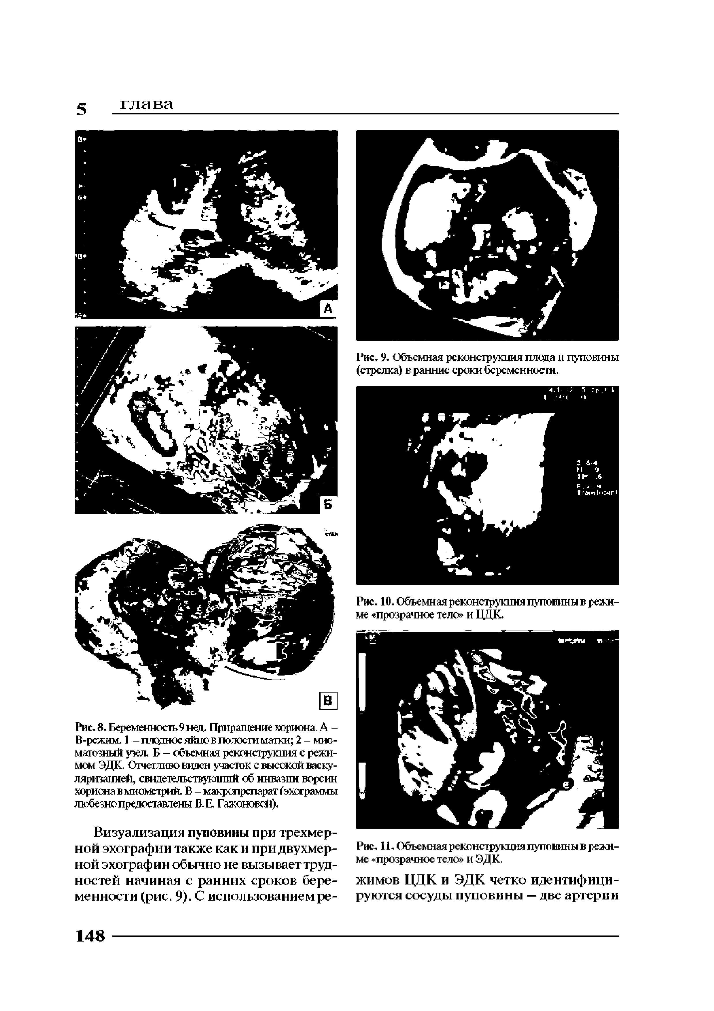 Рис. 8. Беременность 9 нед. Приращение хориона. А -В-режим. 1 — плодное яйцо в полости матки 2 - мио-матозный узел. Б - объемная реконструкция с режимом ЭДК Отчетливо виден участок с высокой васкуляризацией, свидетельствующий об инвазии ворсин мориона в миометрий. В — макропрепарат эхограммы любезно предоставлены ВЕ Гажоновсй).