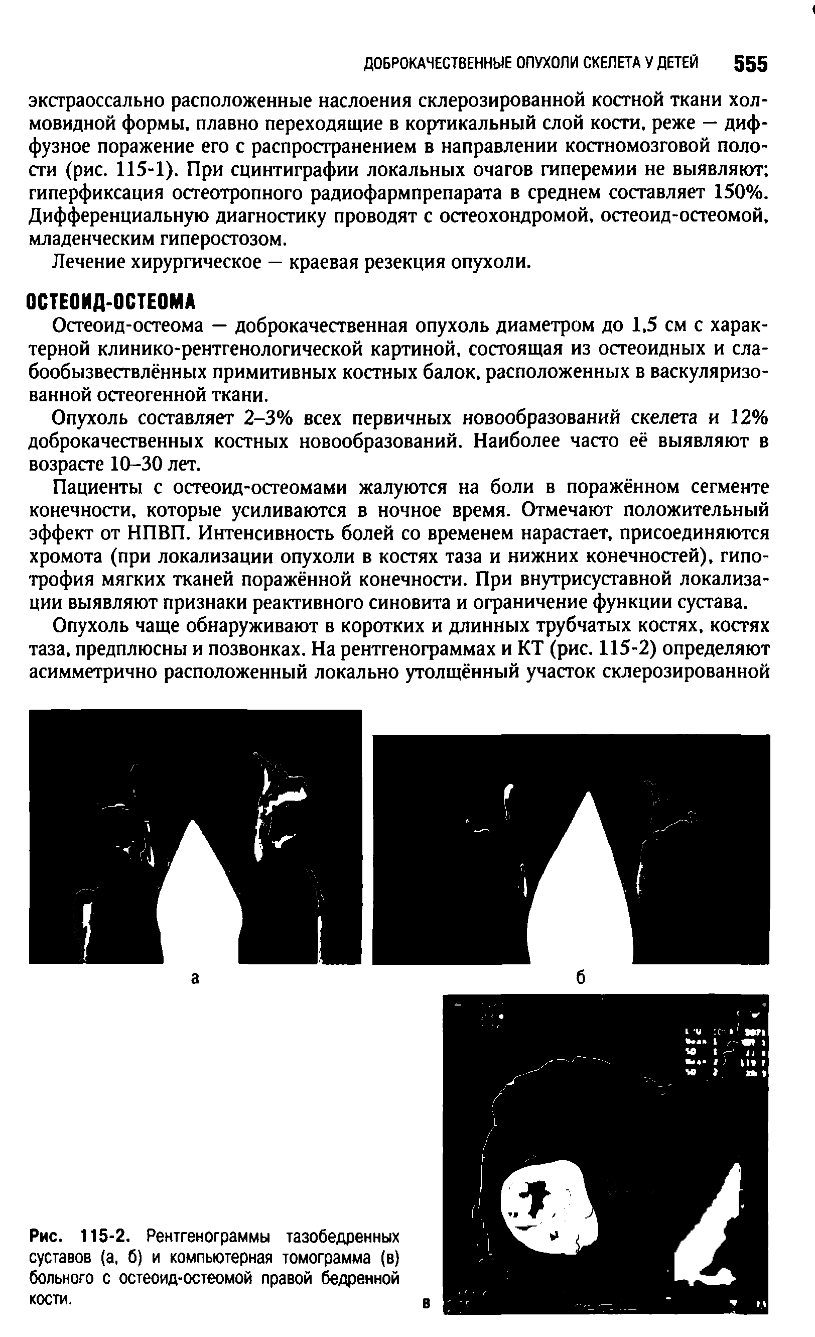 Рис. 115-2. Рентгенограммы тазобедренных суставов (а, б) и компьютерная томограмма (в) больного с остеоид-остеомой правой бедренной кости.