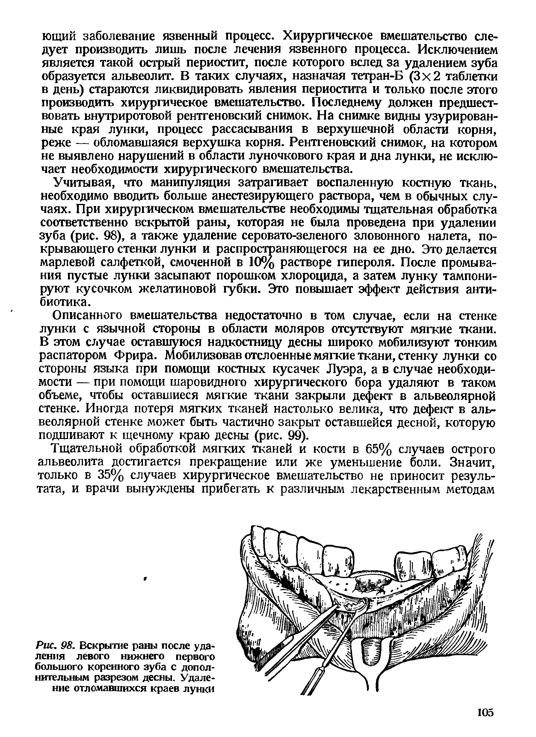 Рис. 98. Вскрытие раны после удаления левого нижнего первого большого коренного зуба с дополнительным разрезом десны. Удаление отломавшихся краев лунки...