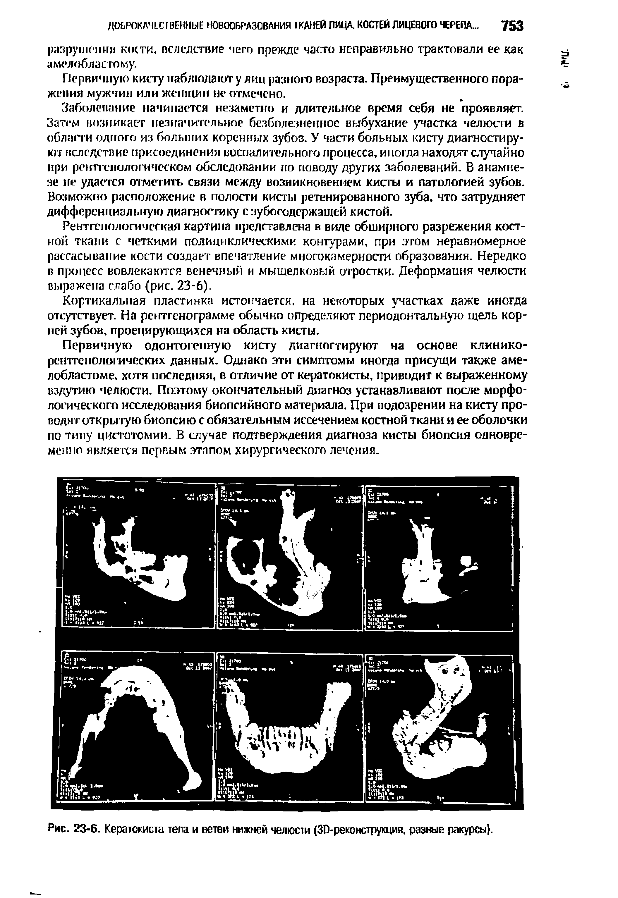 Рис. 23-6. Кератокиста тела и ветви нижней челюсти (30-реконструкция, разные ракурсы).