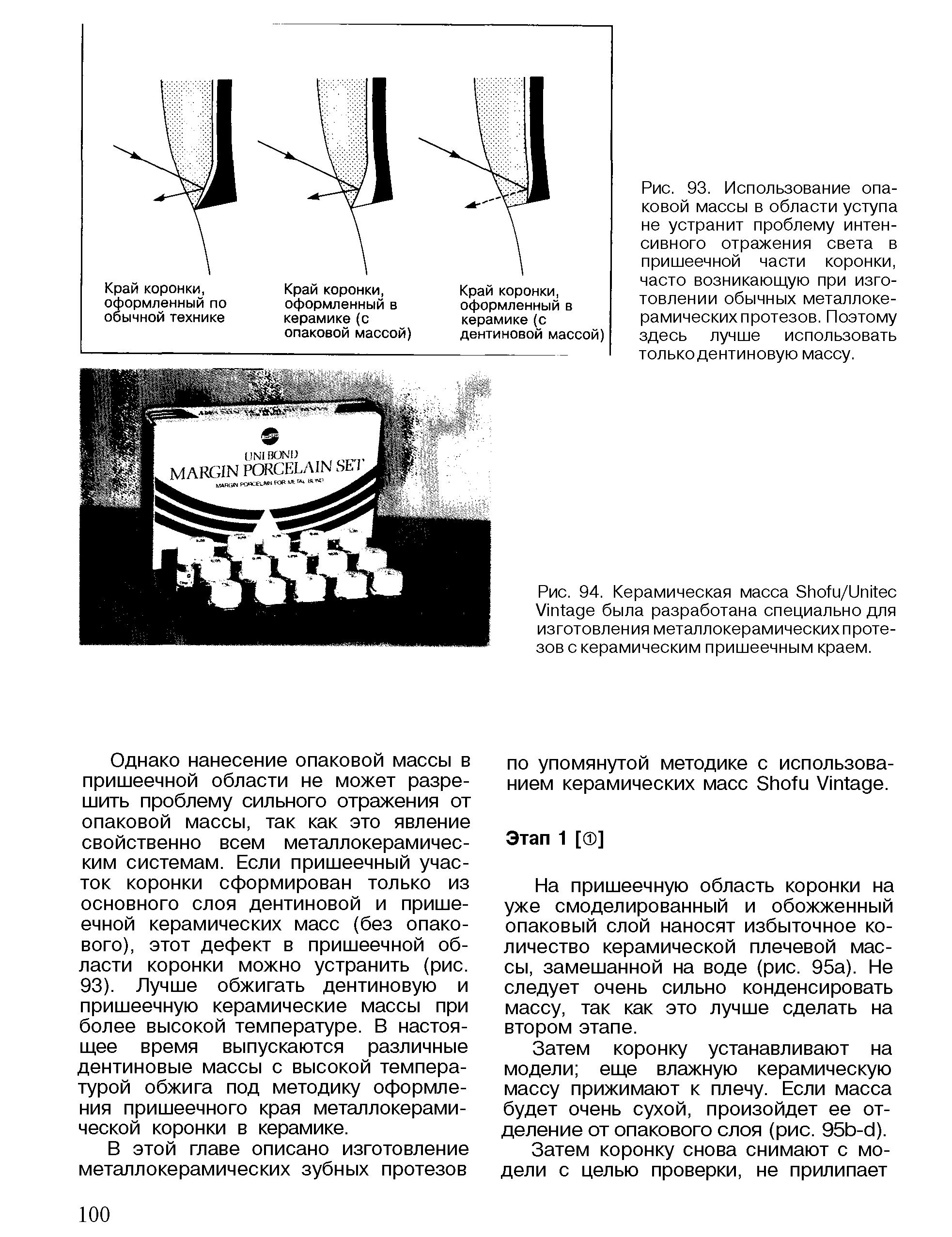 Рис. 93. Использование опаковой массы в области уступа не устранит проблему интенсивного отражения света в пришеечной части коронки, часто возникающую при изготовлении обычных металлокерамических протезов. Поэтому здесь лучше использовать только дентиновую массу.