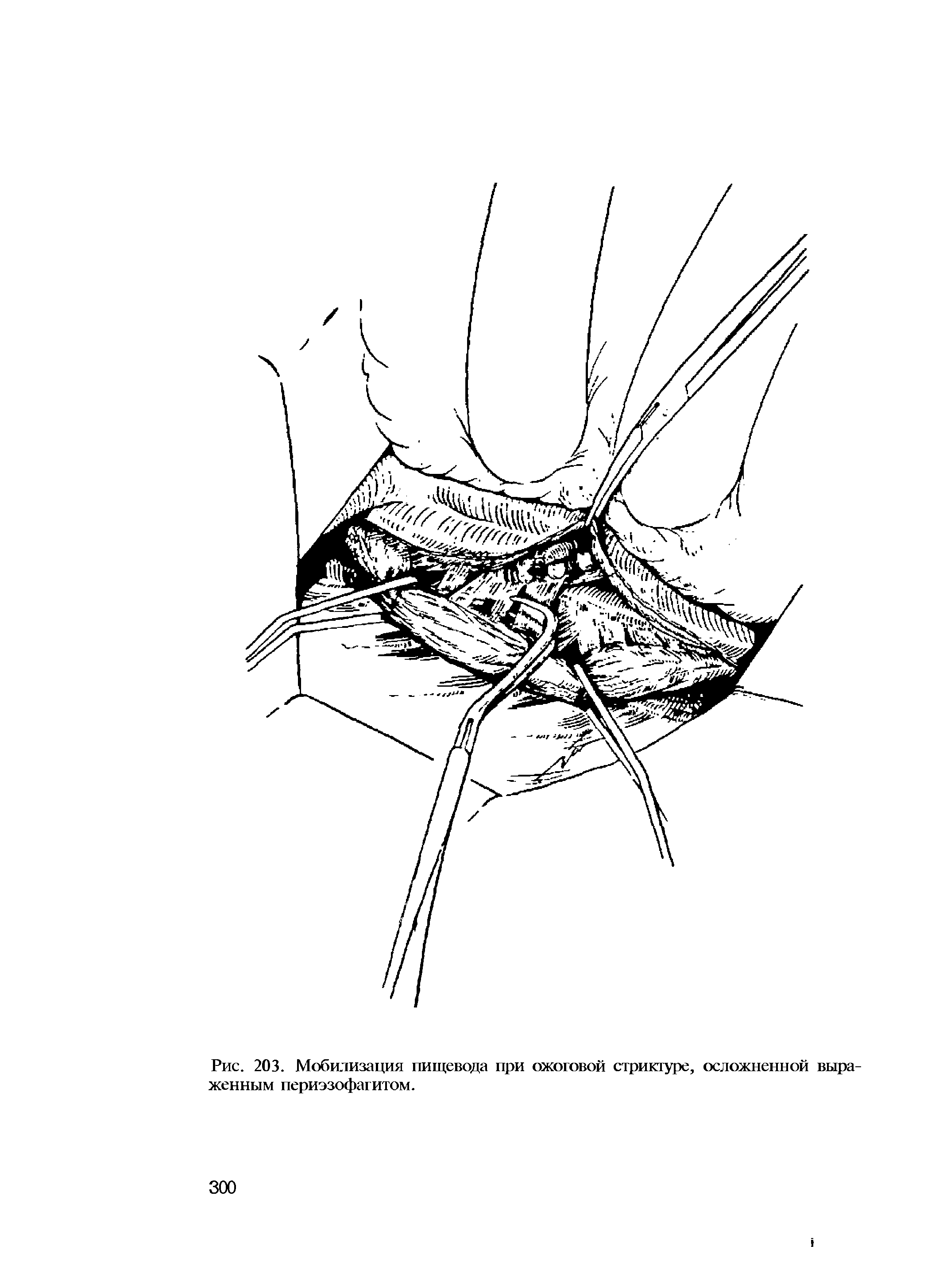 Рис. 203. Мобилизация пищевода при ожоговой стриктуре, осложненной выраженным периэзофагитом.