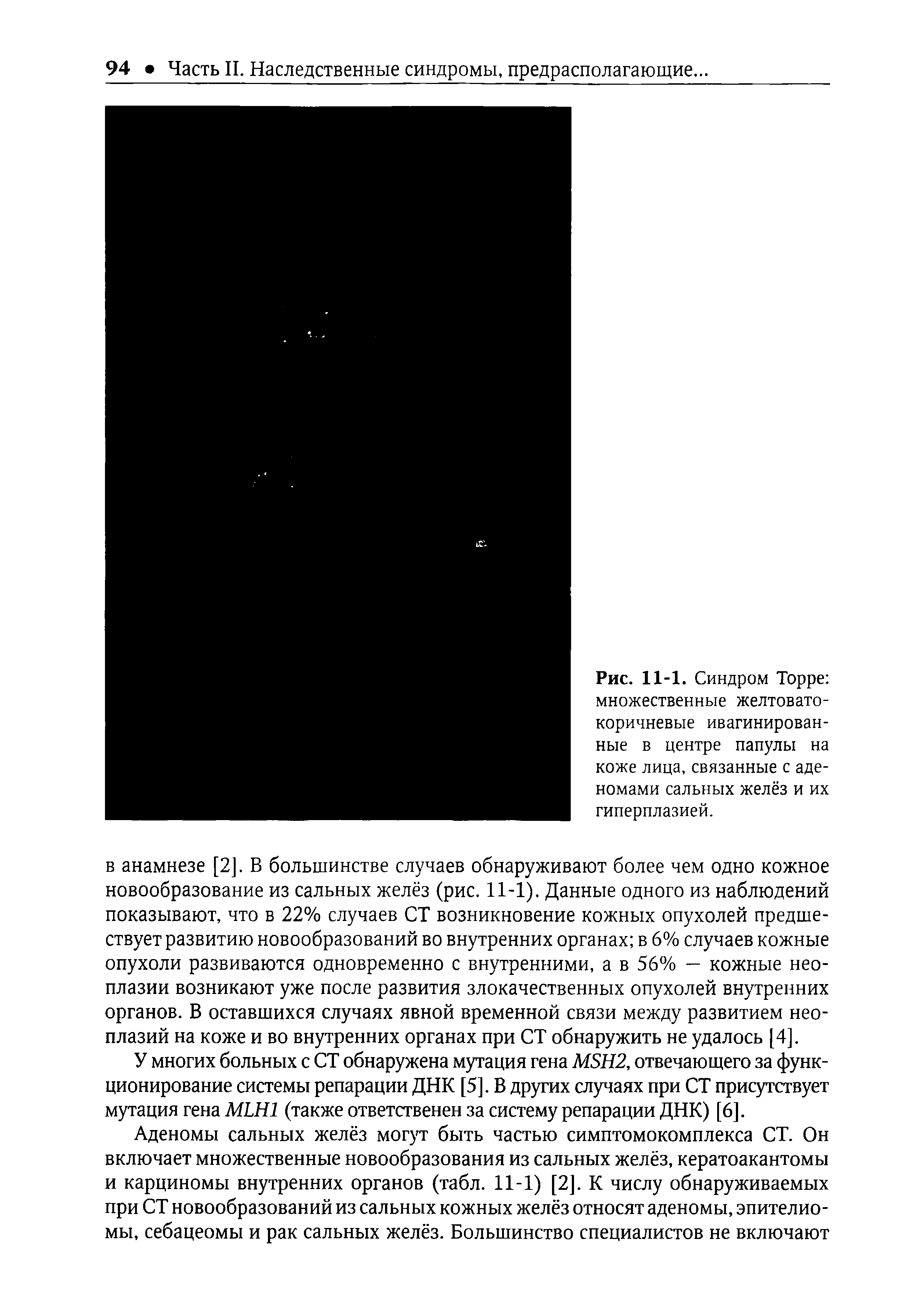 Рис. 11-1. Синдром Торре множественные желтовато-коричневые ивагинирован-ные в центре папулы на коже лица, связанные с аденомами сальных желёз и их гиперплазией.