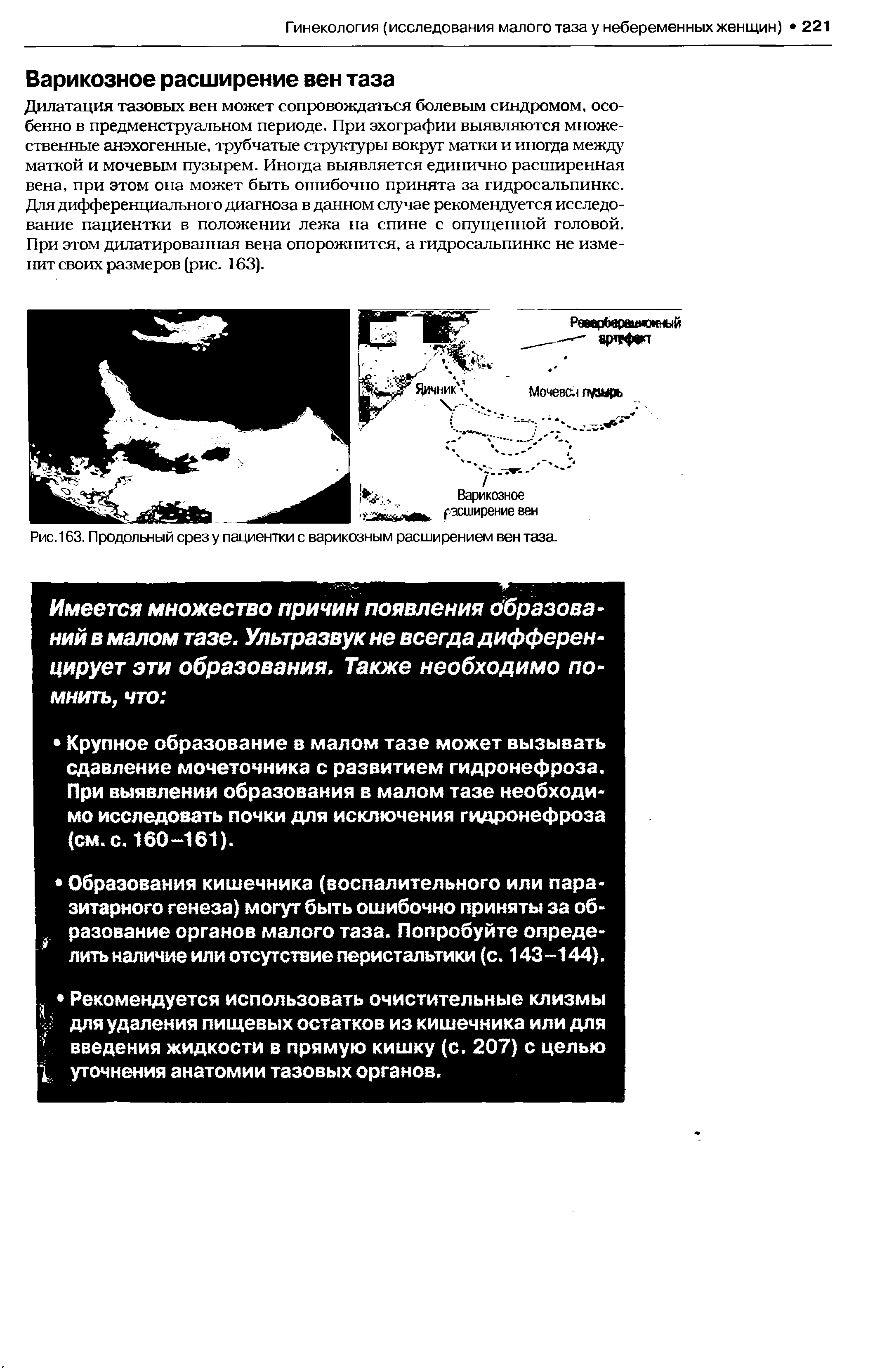 Рис. 163. Продольный срезу пациентки с варикозным расширением вен таза.