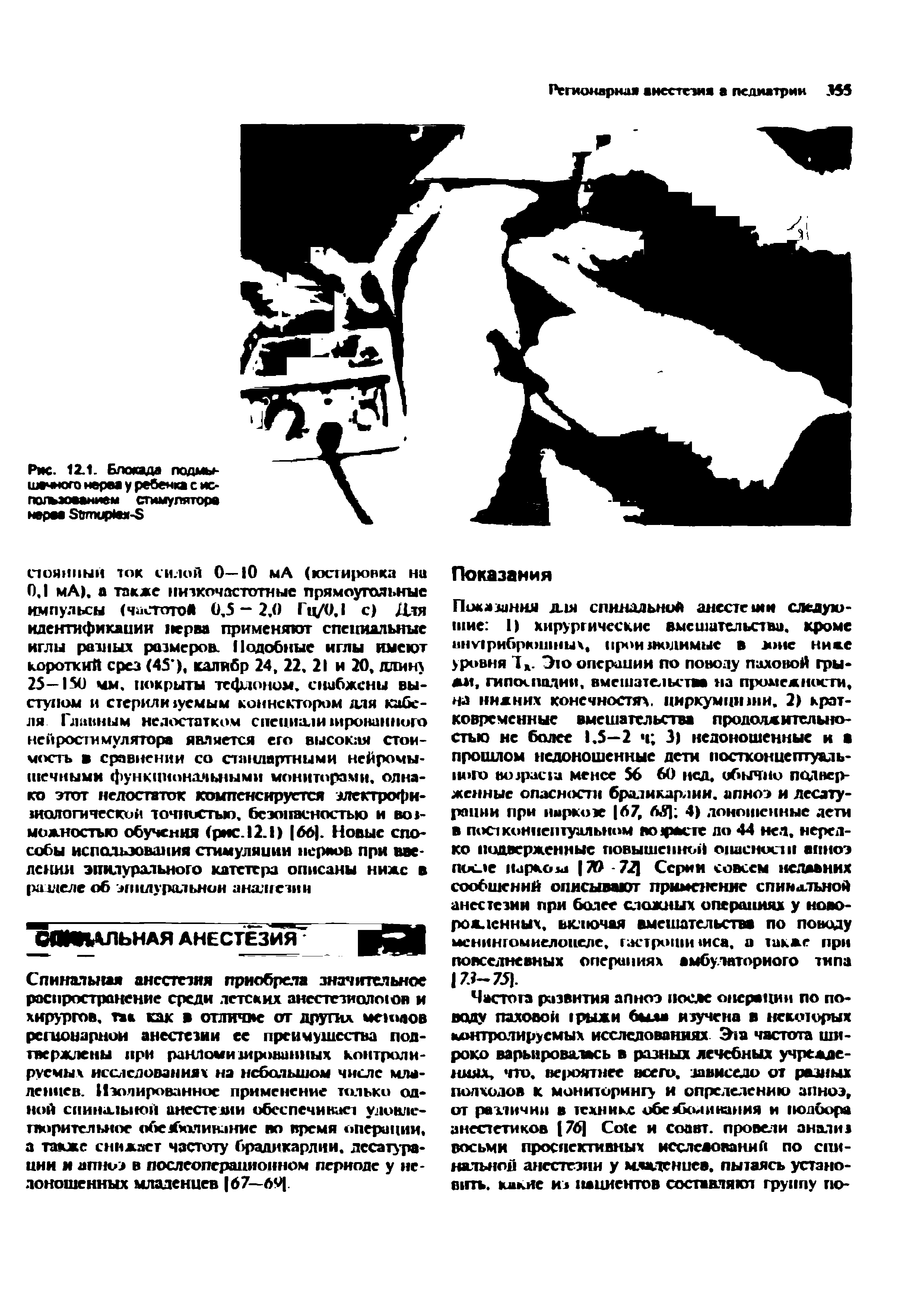 Рис. 12.1. Блокада подмышечного нерва у ребенка с использованием стимулятора нараа S -S...