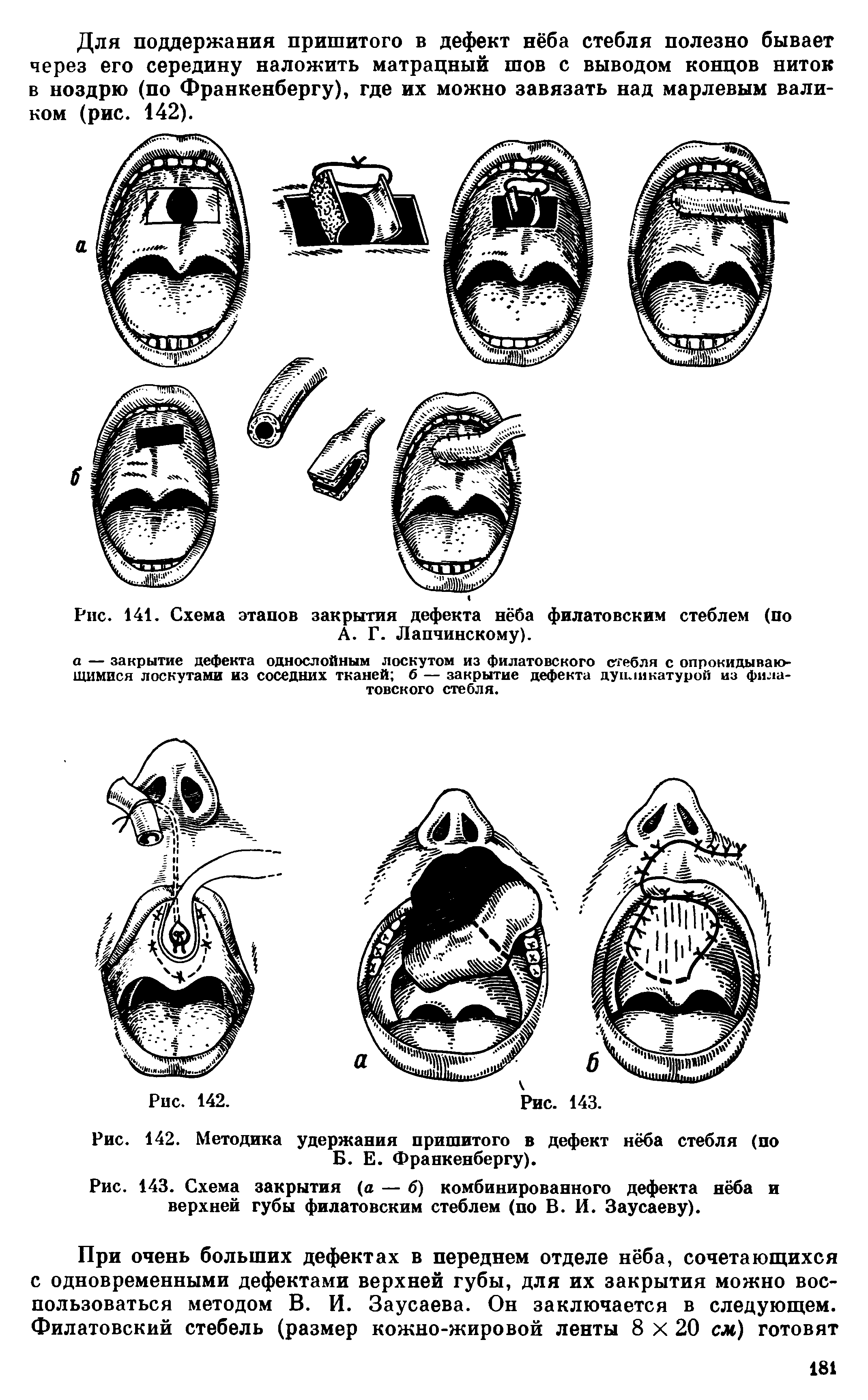Рис. 143. Схема закрытия (а — б) комбинированного дефекта нёба и верхней губы филатовским стеблем (по В. И. Заусаеву).