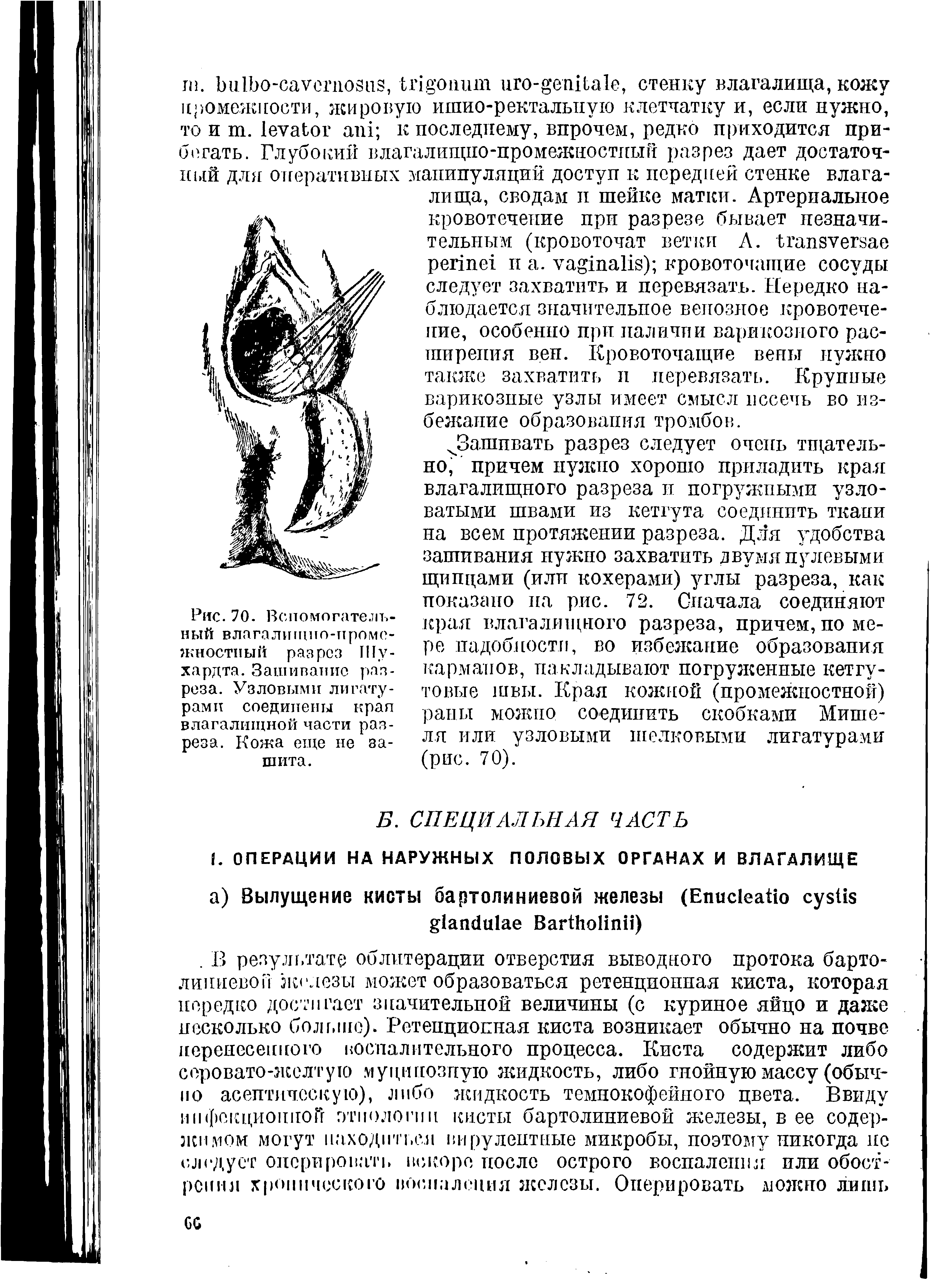 Рис. 70. Вспомогательный влагалищно-промежностный разрез Шуха рд та. Зашивание разреза. Узловыми лигатурами соединены крап влагалищной части разреза. Кожа еще не зашита.