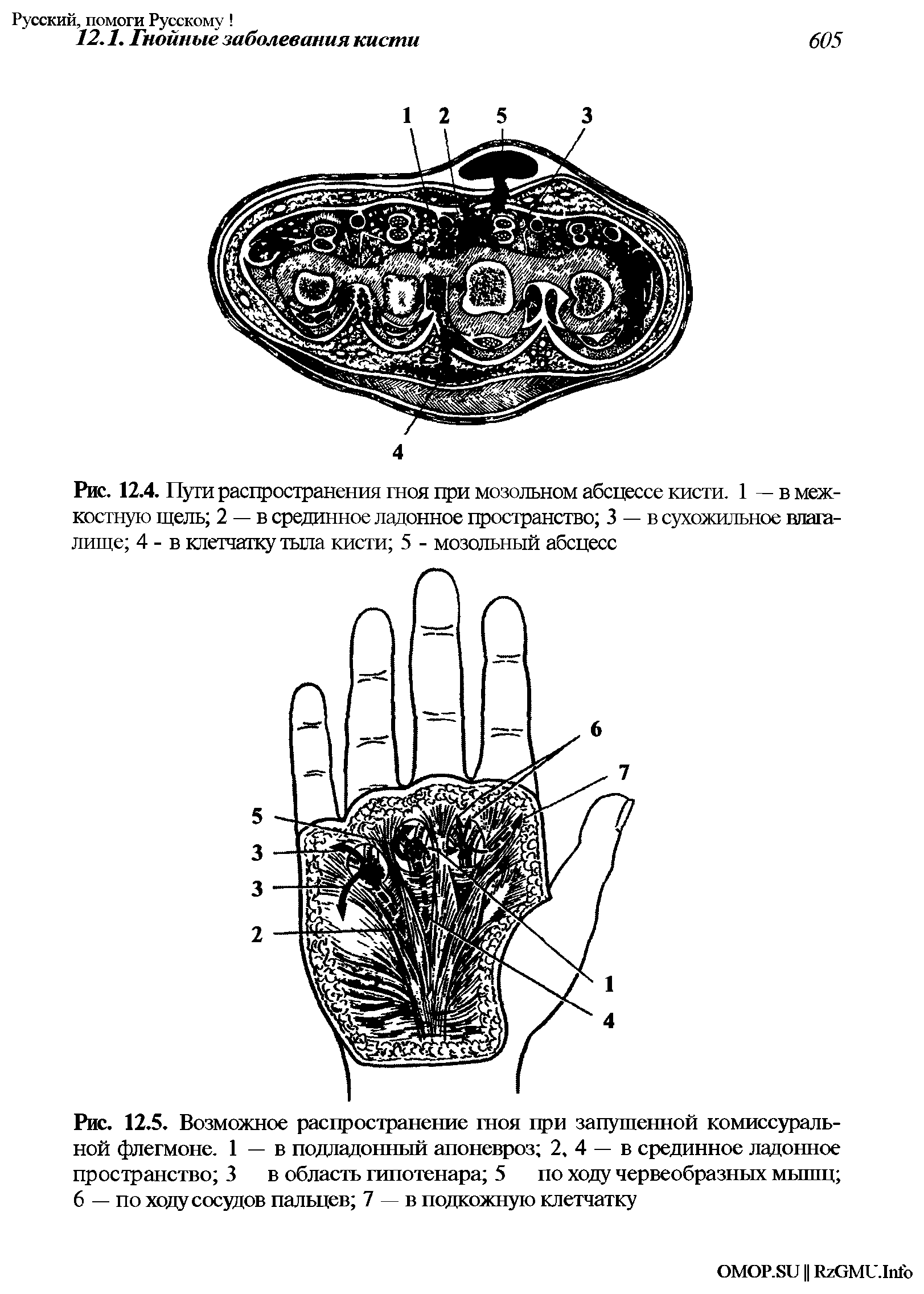 Рис. 12.5. Возможное распространение гноя при запущенной комиссуральной флегмоне. 1 — в подладонный апоневроз 2, 4 — в срединное ладонное пространство 3 в область гипотенара 5 по ходу червеобразных мышц 6 — по ходу сосудов пальцев 7 — в подкожную клетчатку...
