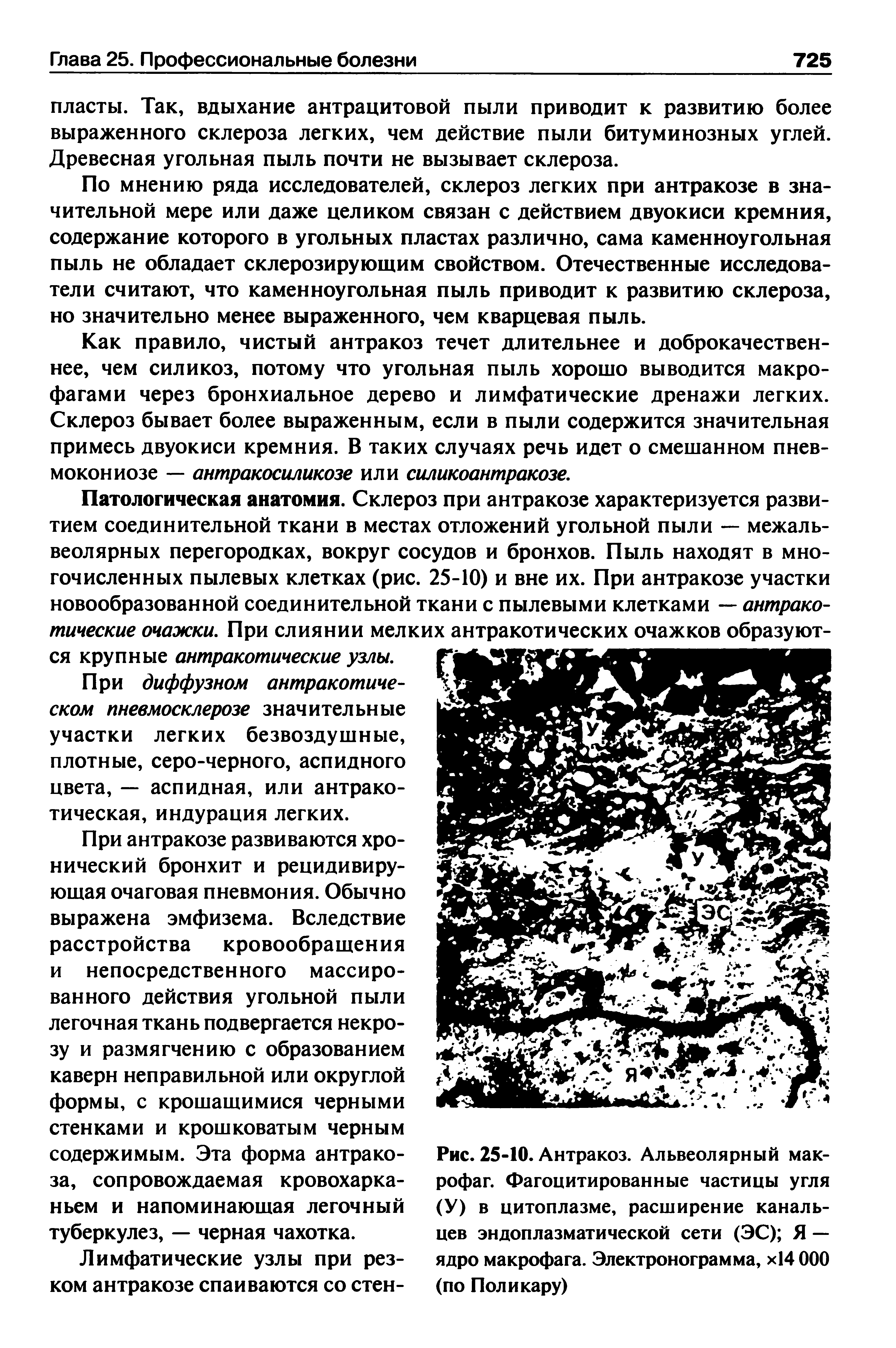 Рис. 25-10. Антракоз. Альвеолярный макрофаг. Фагоцитированные частицы угля (У) в цитоплазме, расширение канальцев эндоплазматической сети (ЭС) Я — ядро макрофага. Электронограмма, х14 ООО (по Поликару)...