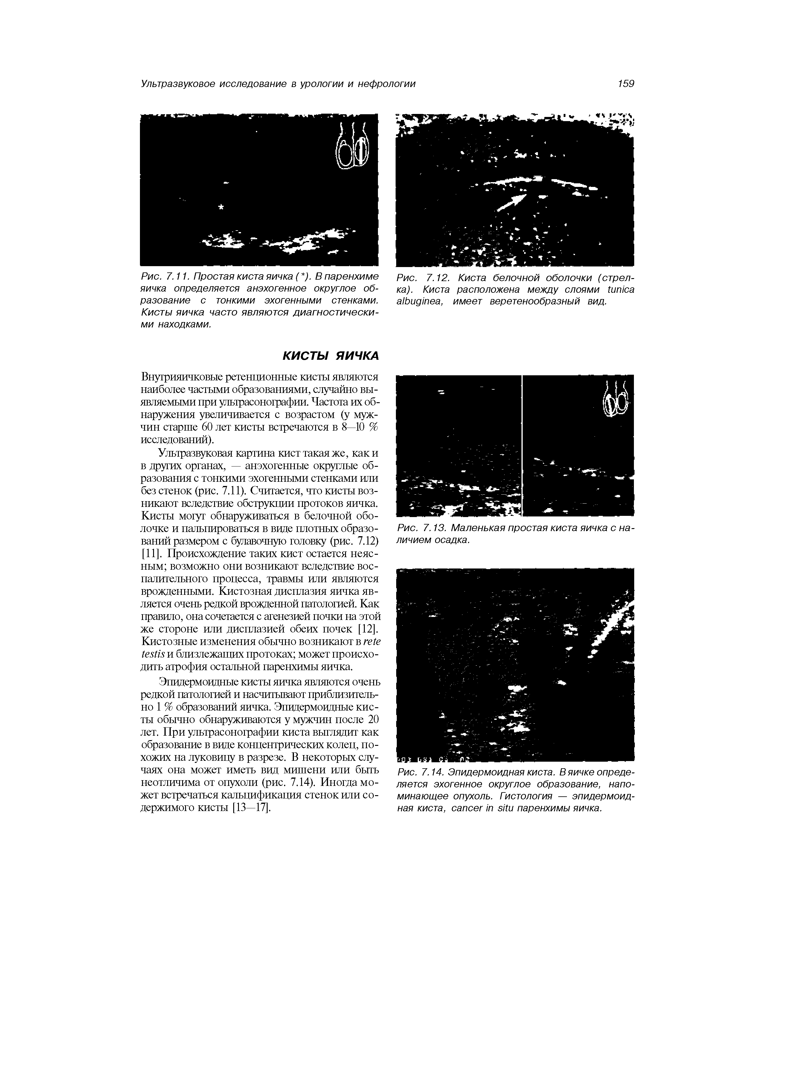 Рис. 7.14. Эпидермоидная киста. В яичке определяется эхогенное округлое образование, напоминающее опухоль. Гистология — эпидермоидная киста, паренхимы яичка.