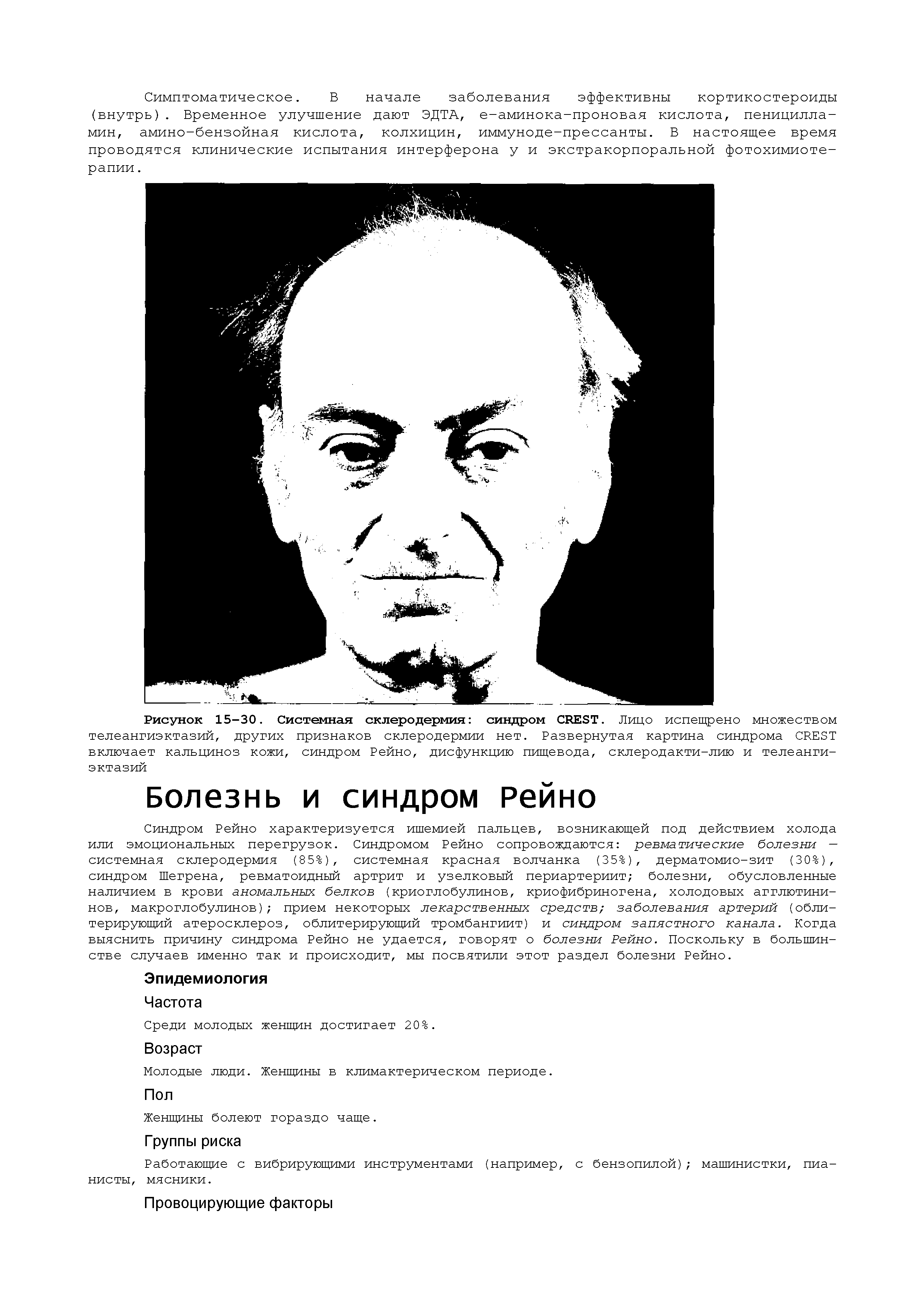 Рисунок 15-30. Системная склеродермия синдром CREST. Лицо испещрено множеством телеангиэктазий, других признаков склеродермии нет. Развернутая картина синдрома CREST включает кальциноз кожи, синдром Рейно, дисфункцию пищевода, склеродакти-лию и телеангиэктазий...