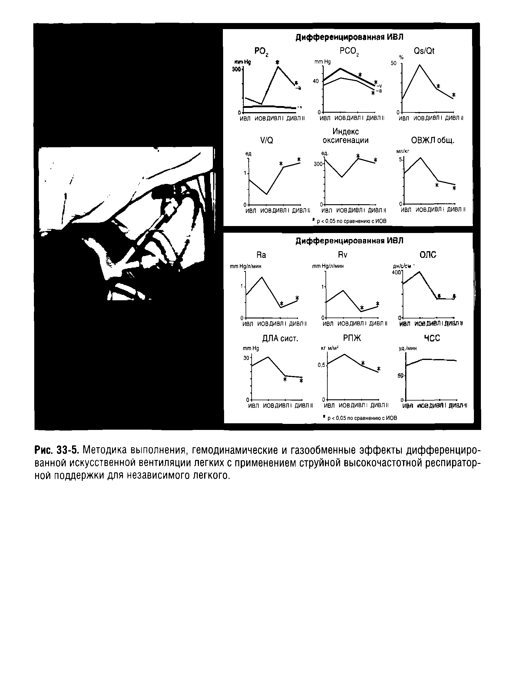 Рис. 33-5. Методика выполнения, гемодинамические и газообменные эффекты дифференцированной искусственной вентиляции легких с применением струйной высокочастотной респираторной поддержки для независимого легкого.
