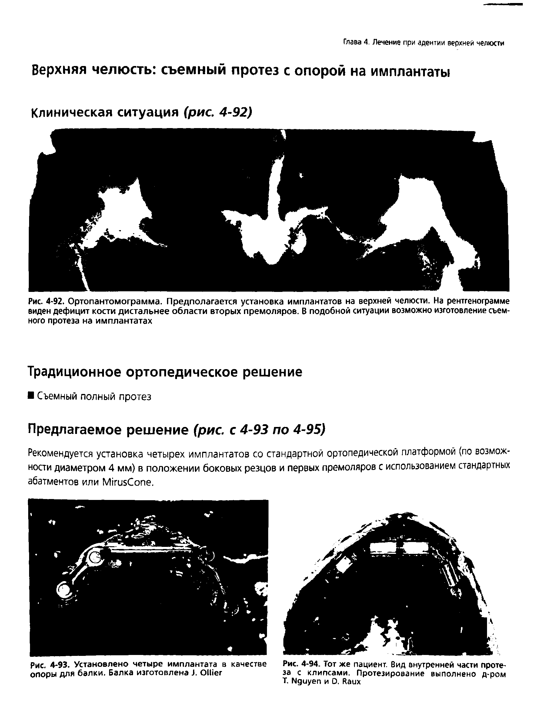 Рис. 4-92. Ортопантомограмма. Предполагается установка имплантатов на верхней челюсти. На рентгенограмме виден дефицит кости дистальнее области вторых премоляров. В подобной ситуации возможно изготовление съемного протеза на имплантатах...