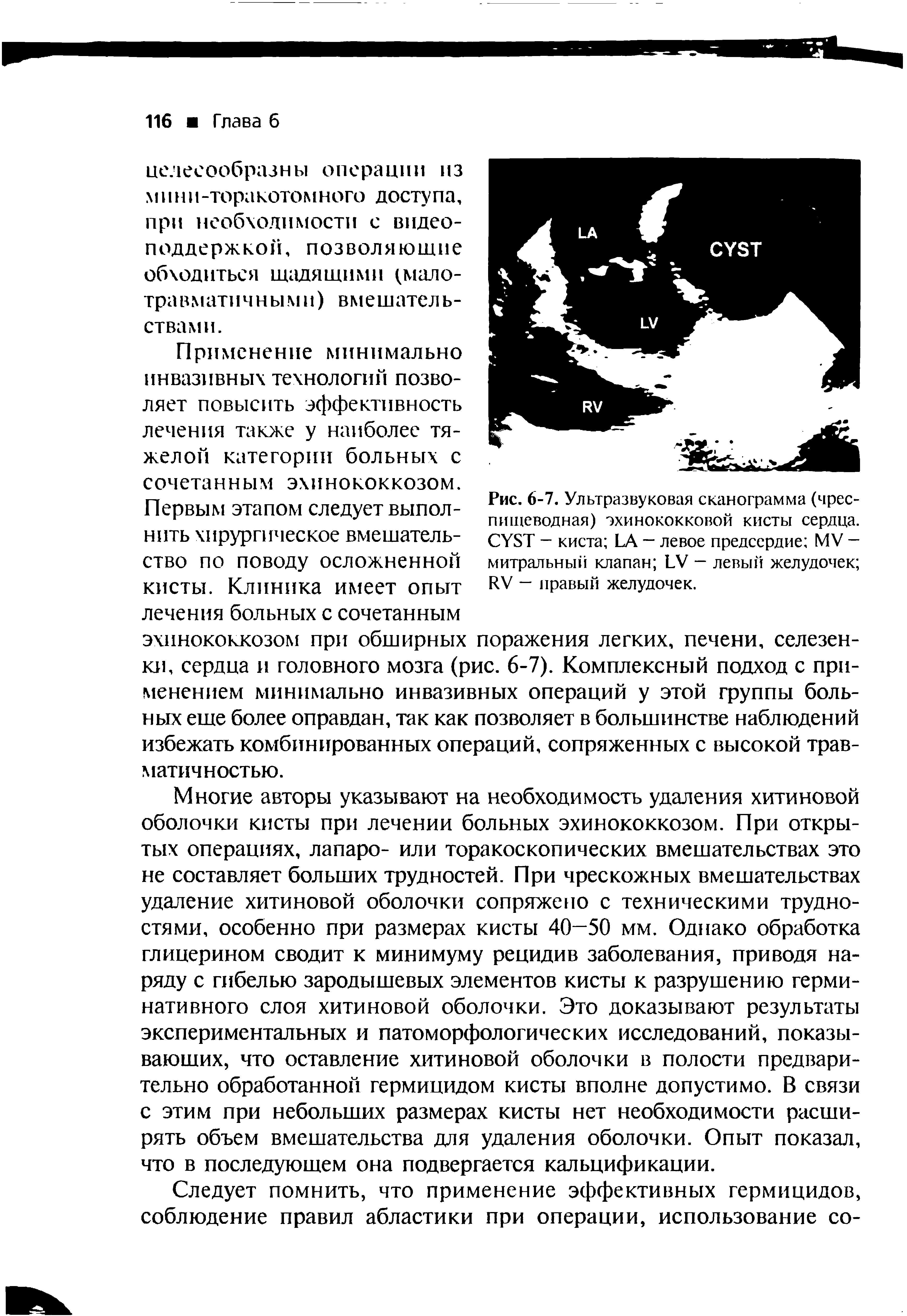 Рис. 6-7. Ультразвуковая сканограмма (чреспищеводная) эхинококковой кисты сердца. CYST - киста LA — левое предсердие MV -митральный клапан LV — левый желудочек RV — правый желудочек.