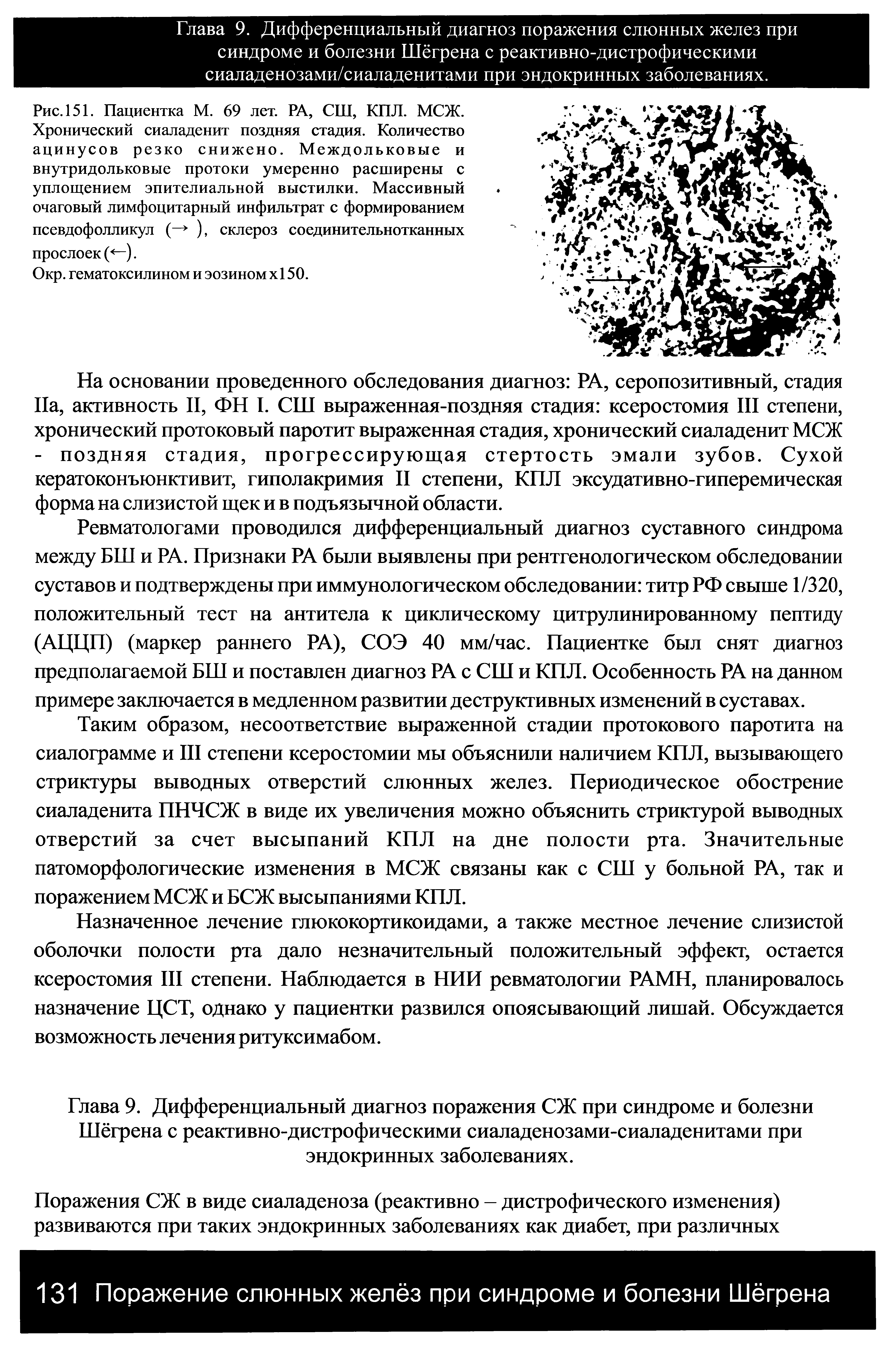 Рис. 151. Пациентка М. 69 лет. РА, СШ, КПЛ. МСЖ. Хронический сиаладенит поздняя стадия. Количество ацинусов резко снижено. Междольковые и внутридольковые протоки умеренно расширены с уплощением эпителиальной выстилки. Массивный очаговый лимфоцитарный инфильтрат с формированием псевдофолликул (— ), склероз соединительнотканных прослоек( —).