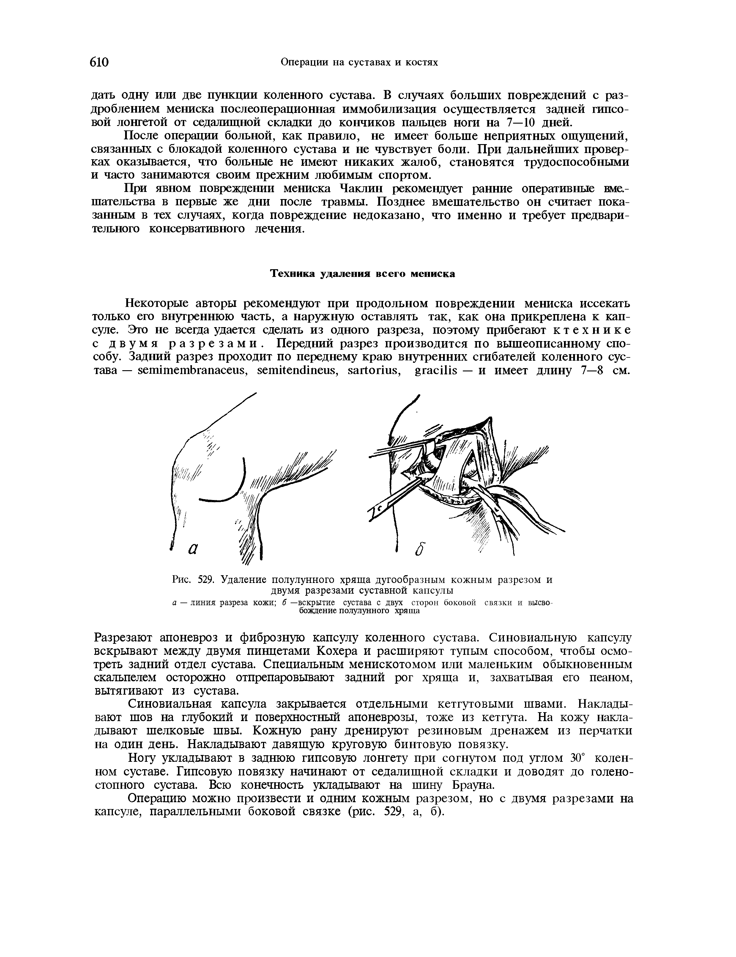 Рис. 529. Удаление полулунного хряща дугообразным кожным разрезом и двумя разрезами суставной капсулы...