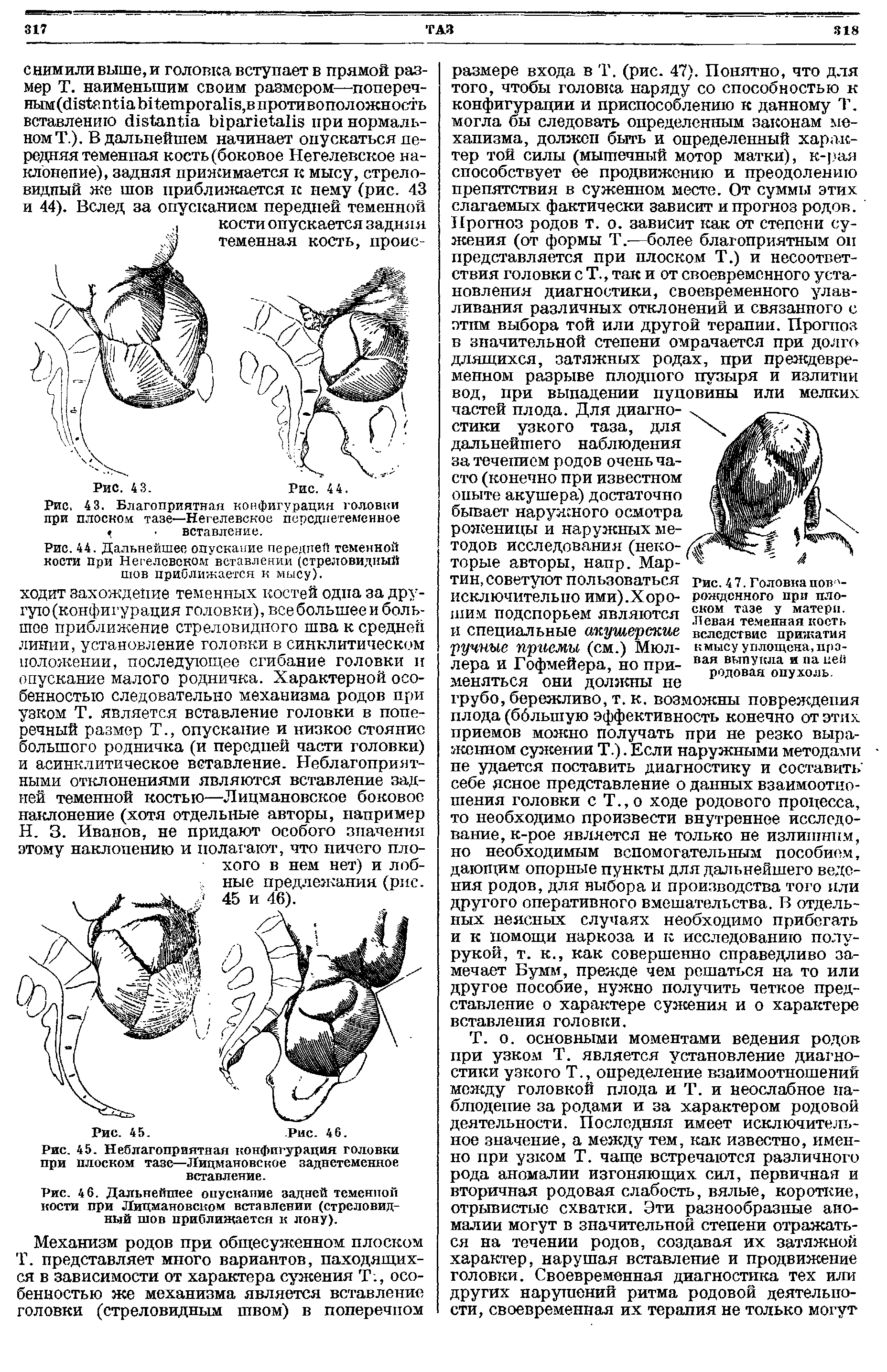 Рис. 45. Неблагоприятная конфигурация головки при плоском тазе—Лицмановское заднетеменное вставление.