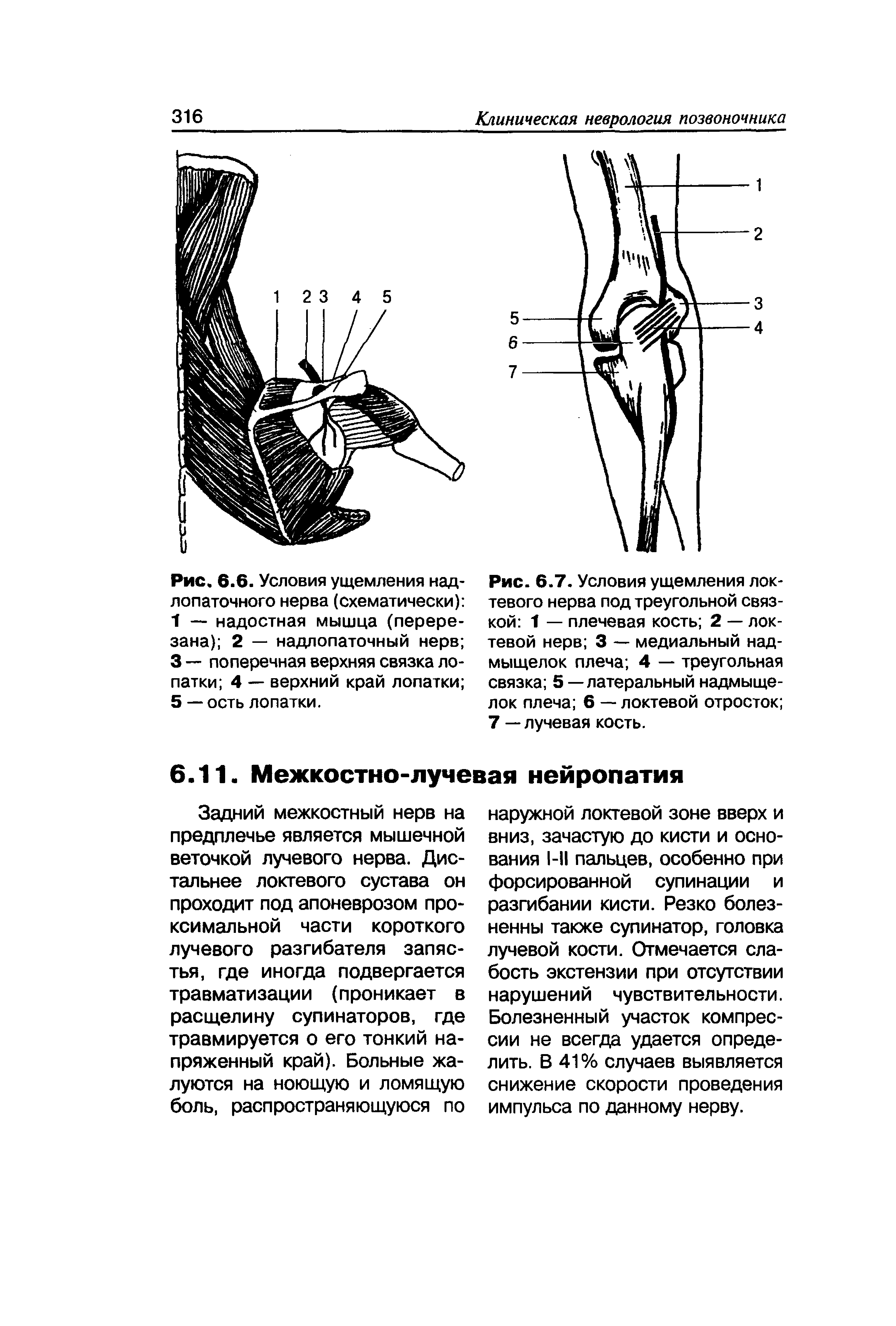 Рис. 6.7. Условия ущемления локтевого нерва под треугольной связкой 1 — плечевая кость 2 — локтевой нерв 3 — медиальный надмыщелок плеча 4 — треугольная связка 5 — латеральный надмыщелок плеча 6 — локтевой отросток 7 — лучевая кость.