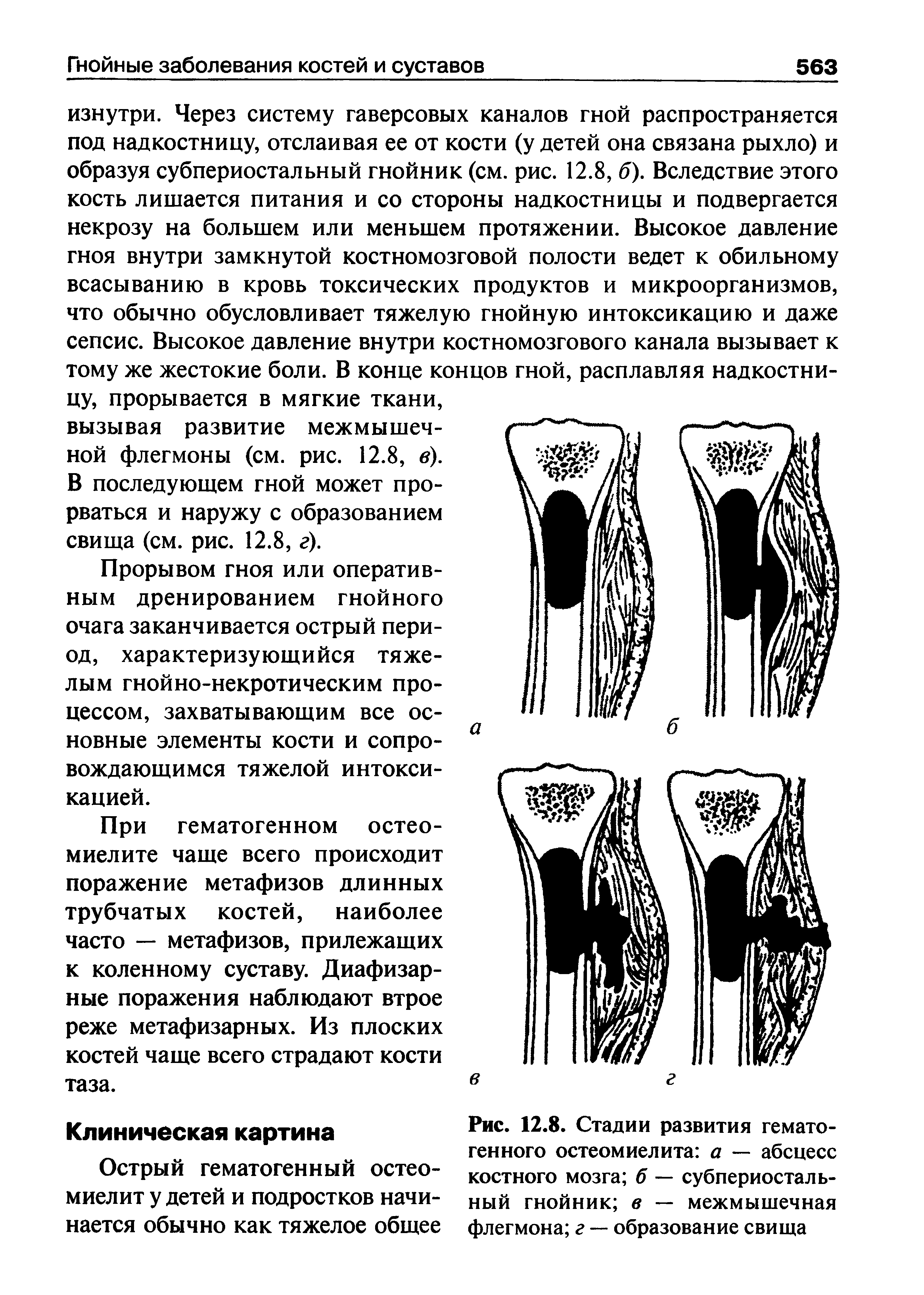 Рис. 12.8. Стадии развития гематогенного остеомиелита а — абсцесс костного мозга б — субпериостальный гнойник в — межмышечная флегмона г — образование свища...