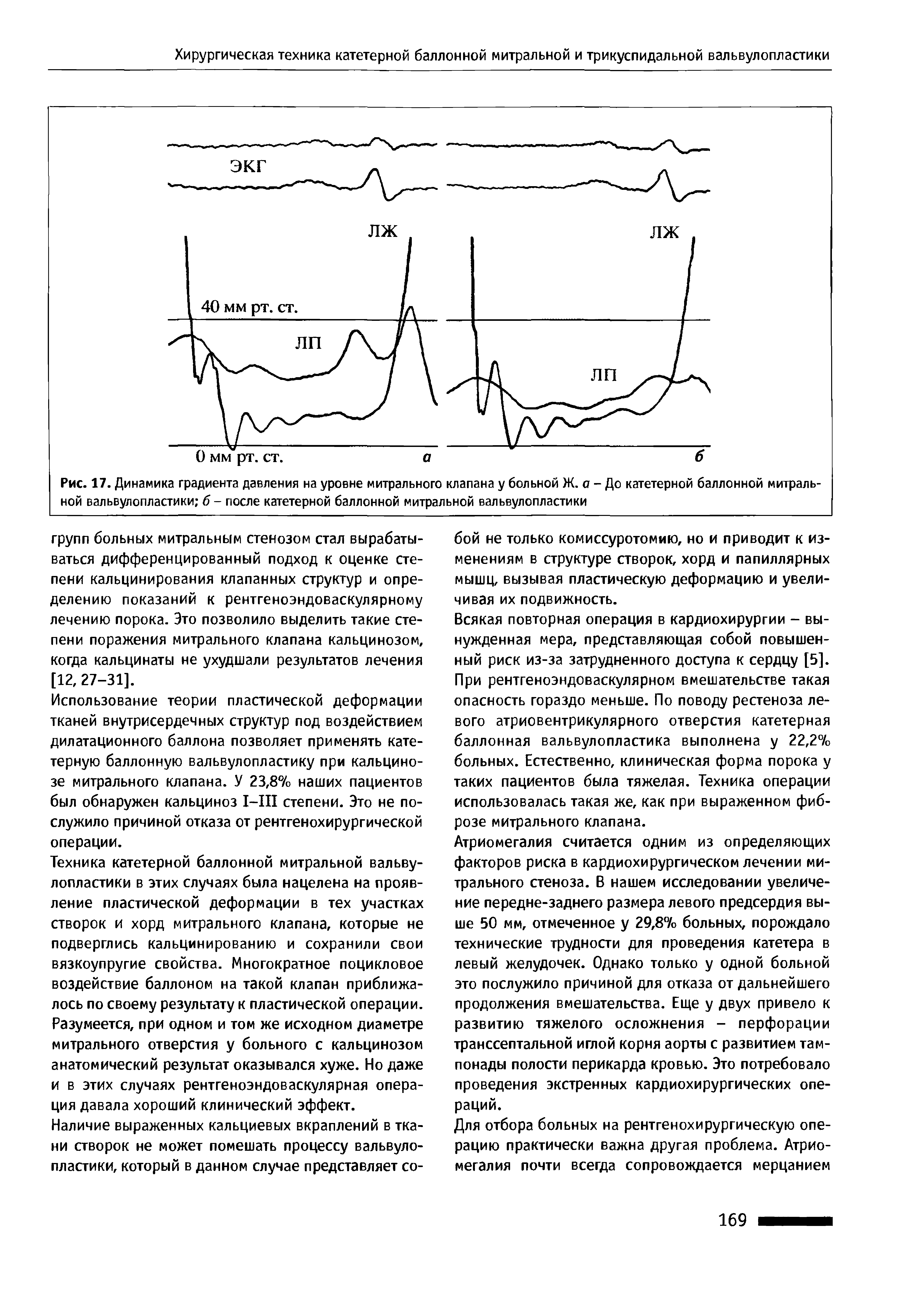 Рис. 17. Динамика градиента давления на уровне митрального клапана у больной Ж. а - До катетерной баллонной митральной вальвулопластики б - после катетерной баллонной митральной вальвулопластики...