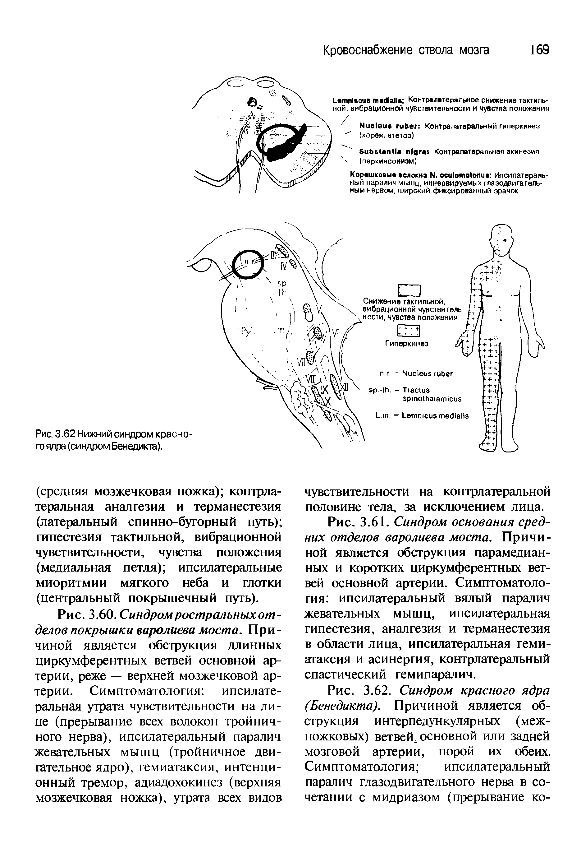 Рис. 3.62. Синдром красного ядра (Бенедикта). Причиной является обструкция интерпедункулярных (межножковых) ветвей, основной или задней мозговой артерии, порой их обеих. Симптоматология ипсилатеральный паралич глазодвигательного нерва в сочетании с мидриазом (прерывание ко-...