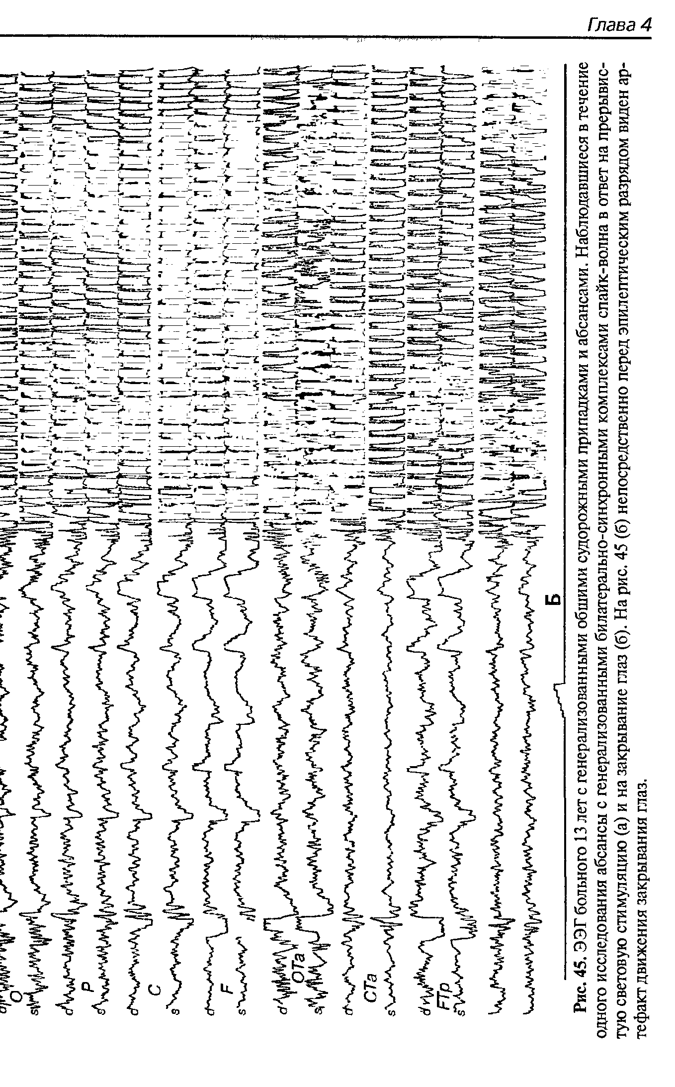 Рис. 45. ЭЭГ больного 13 лет с генерализованными обшими судорожными припадками и абсансами. Наблюдавшиеся в течение одного исследования абсансы с генерализованными билатерально-синхронными комплексами спайк-волна в ответ на прерывистую световую стимуляцию (а) и на закрывание глаз (б). На рис. 45 (б) непосредственно перед эпилептическим разрядом виден артефакт движения закрывания глаз.